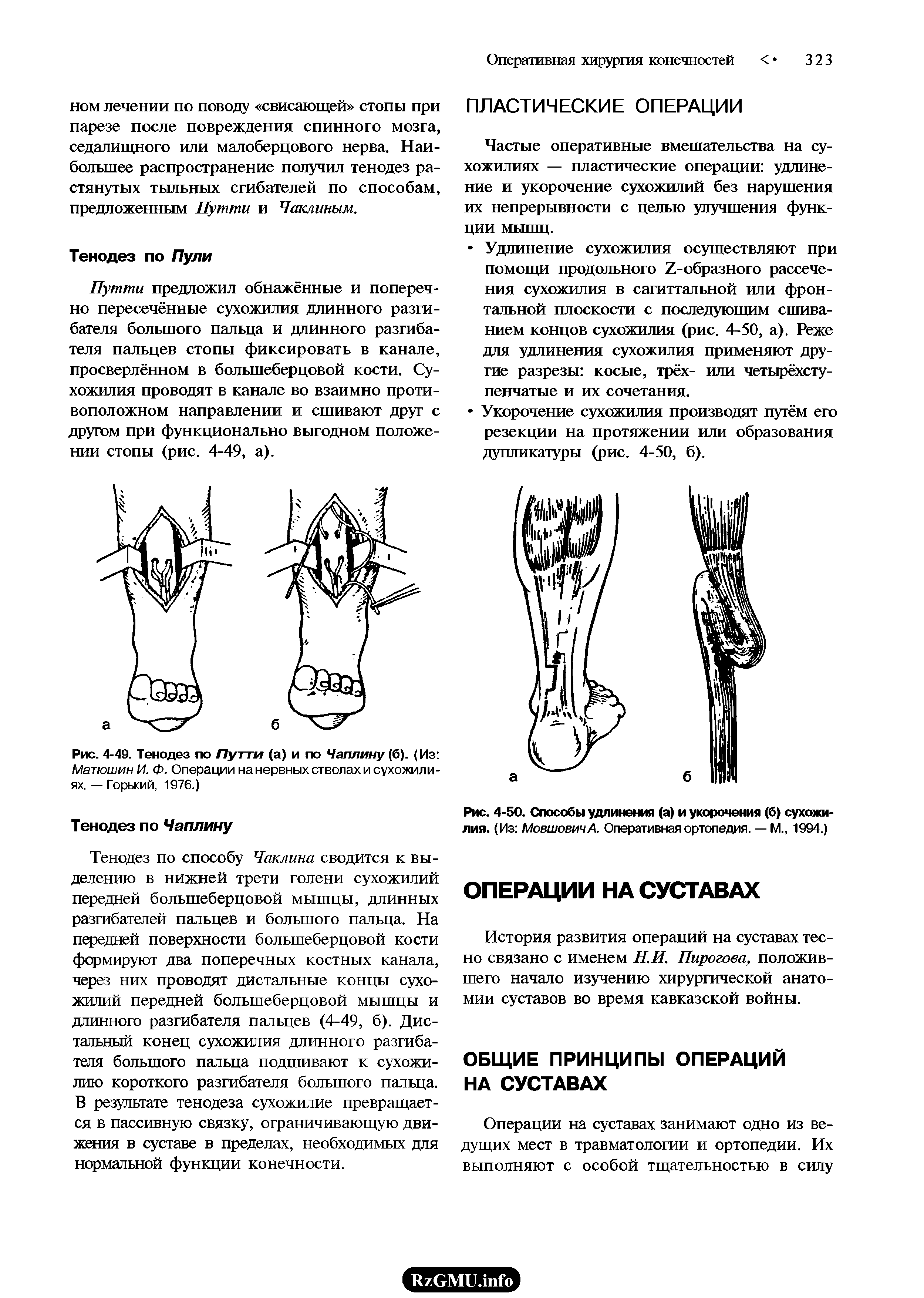 Рис. 4-49. Тенодез по Путти (а) и по Чаплину (6). (Из Матюшин И. Ф. Операции на нервных стволах и сухожилиях. — Горький, 1976.)...