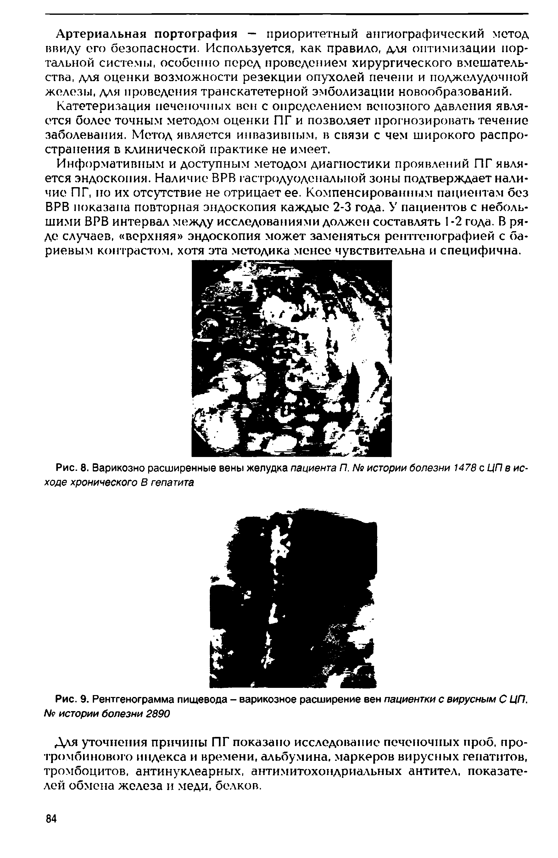 Рис. 8. Варикозно расширенные вены желудка пациента П. № истории болезни 1478 с ЦП в исходе хронического В гепатита...