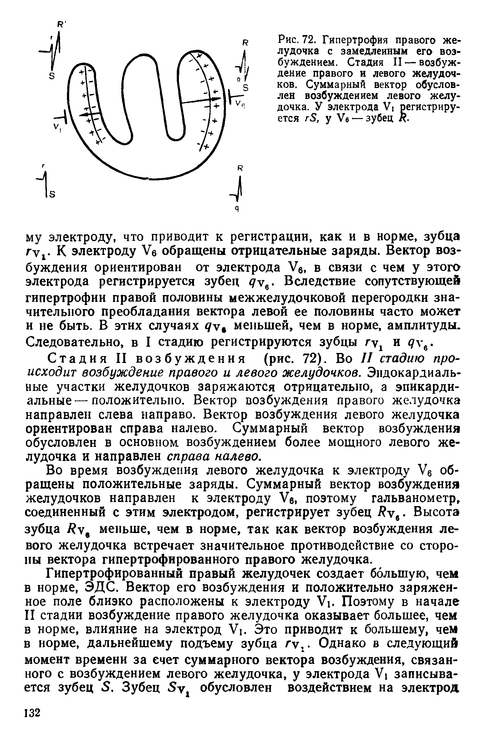 Рис. 72. Гипертрофия правого желудочка с замедленным его возбуждением. Стадия II — возбуждение правого и левого желудочков. Суммарный вектор обусловлен возбуждением левого желудочка. У электрода У1 регистрируется гЯ, у V — зубец / .