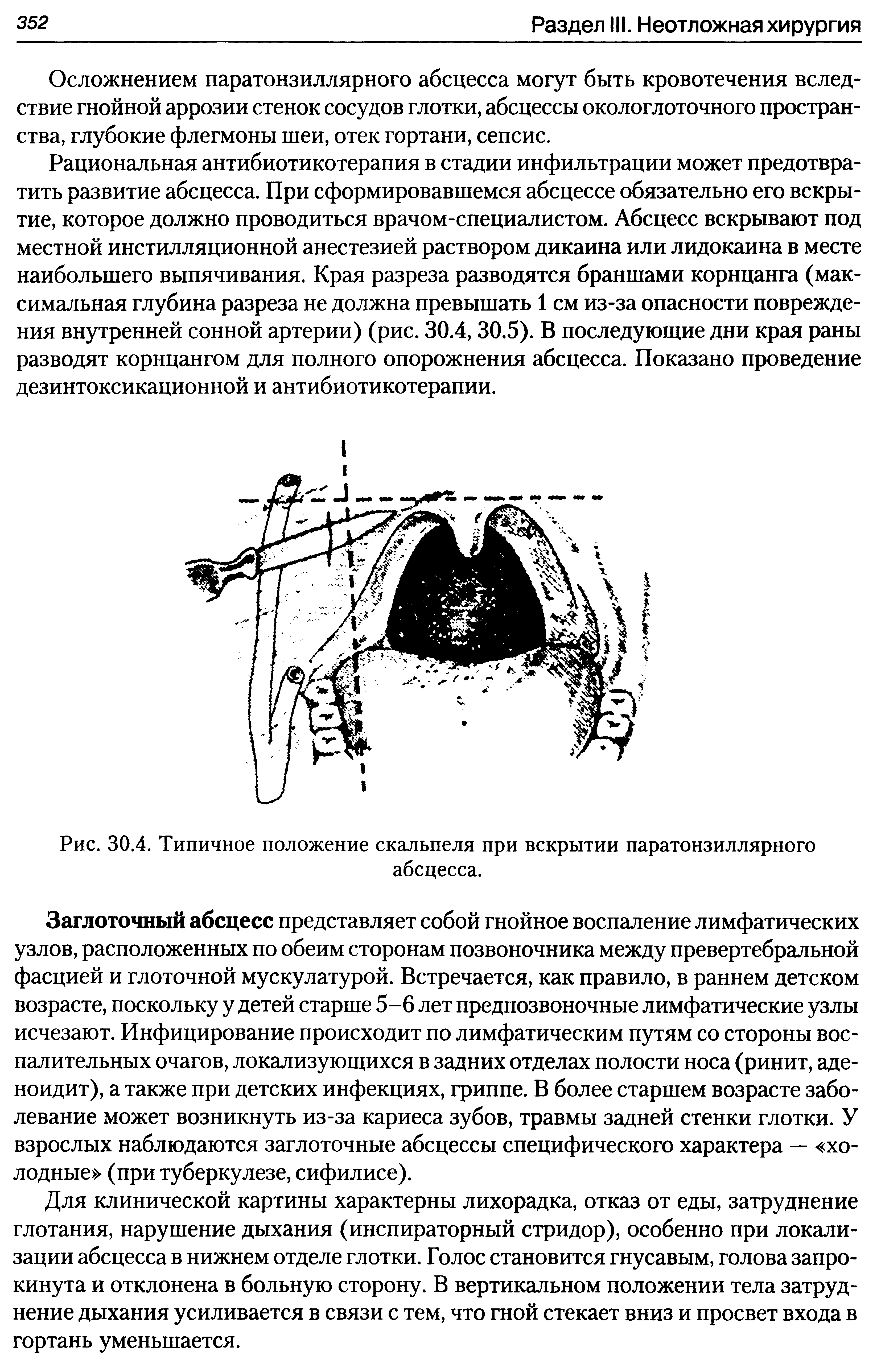 Рис. 30.4. Типичное положение скальпеля при вскрытии паратонзиллярного абсцесса.