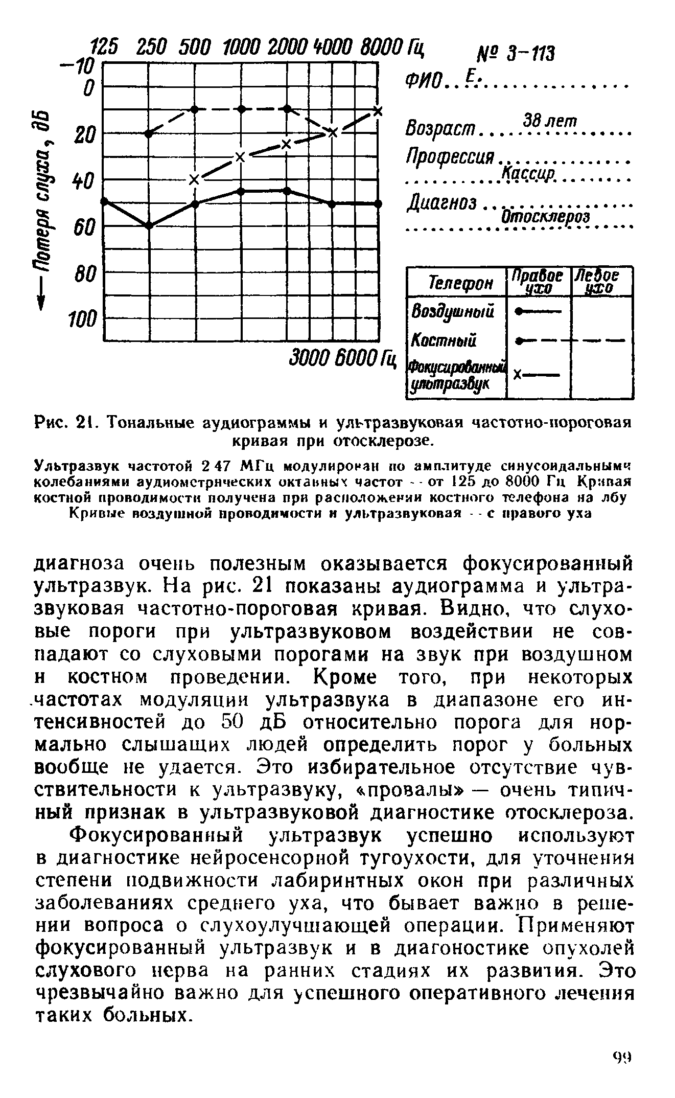 Рис. 21. Тональные аудиограммы и ультразвуковая частотно-пороговая кривая при отосклерозе.