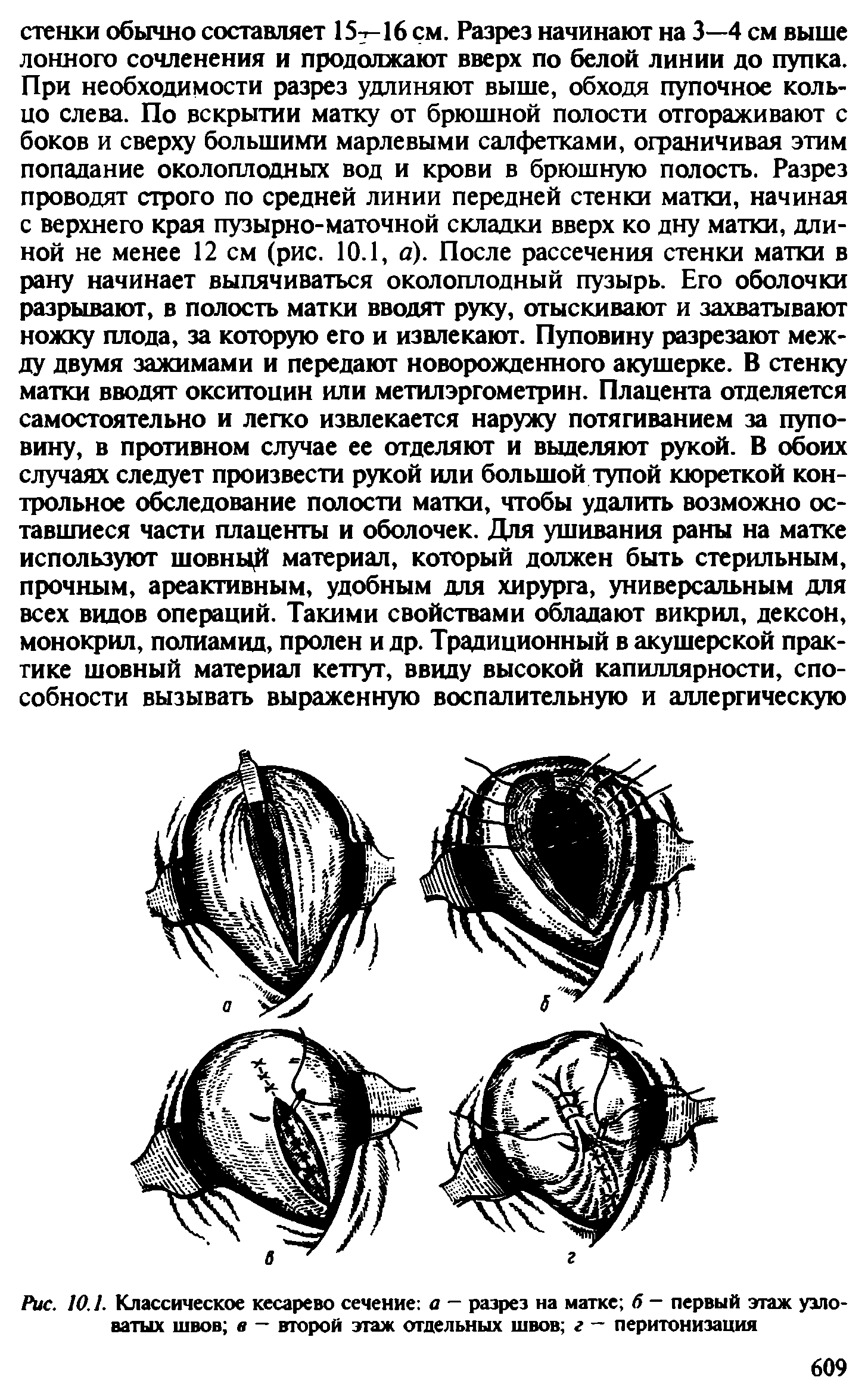 Рис. 10.1. Классическое кесарево сечение а — разрез на матке б - первый этаж узловатых швов в — второй этаж отдельных швов г — перитонизация...