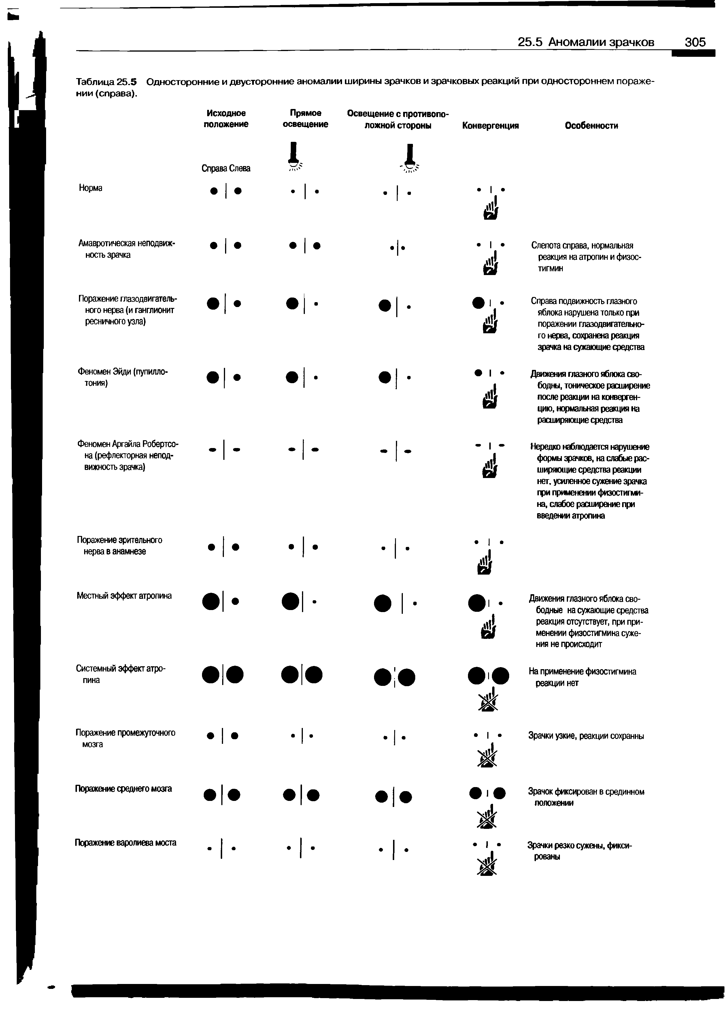 Таблица 25.5 Односторонние и двусторонние аномалии ширины зрачков и зрачковых реакций при одностороннем поражении (справа).
