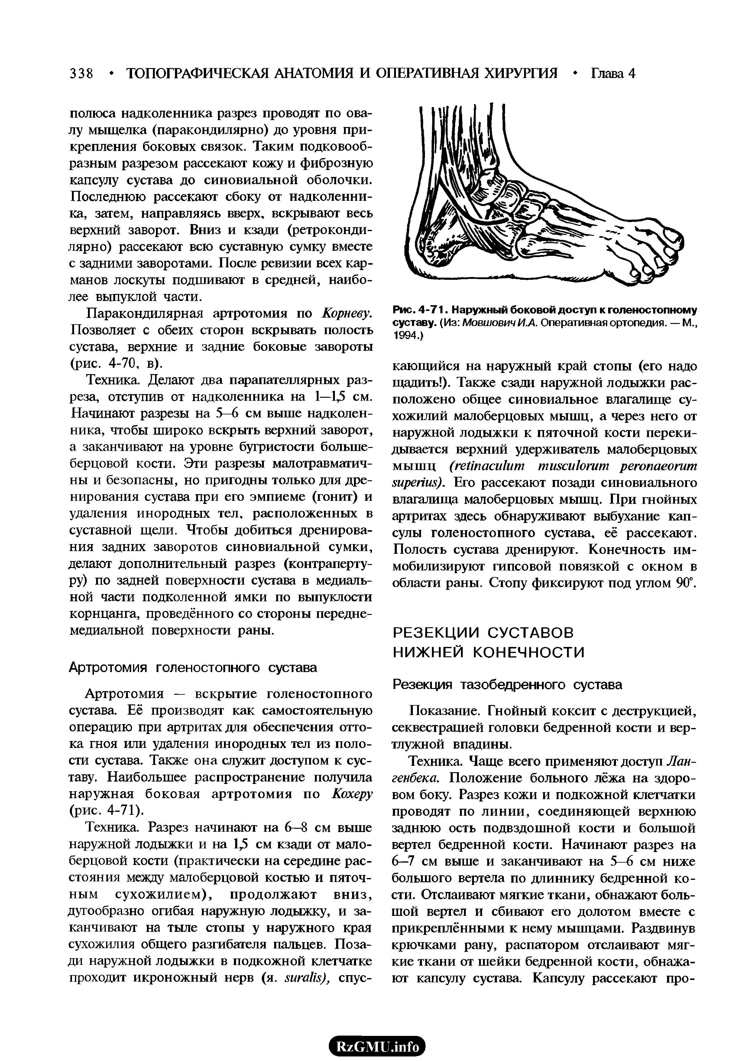 Рис. 4-71. Наружный боковой доступ к голеностопному суставу. (Из МовшовичИ.А. Оперативная ортопедия. — М., 1994.)...