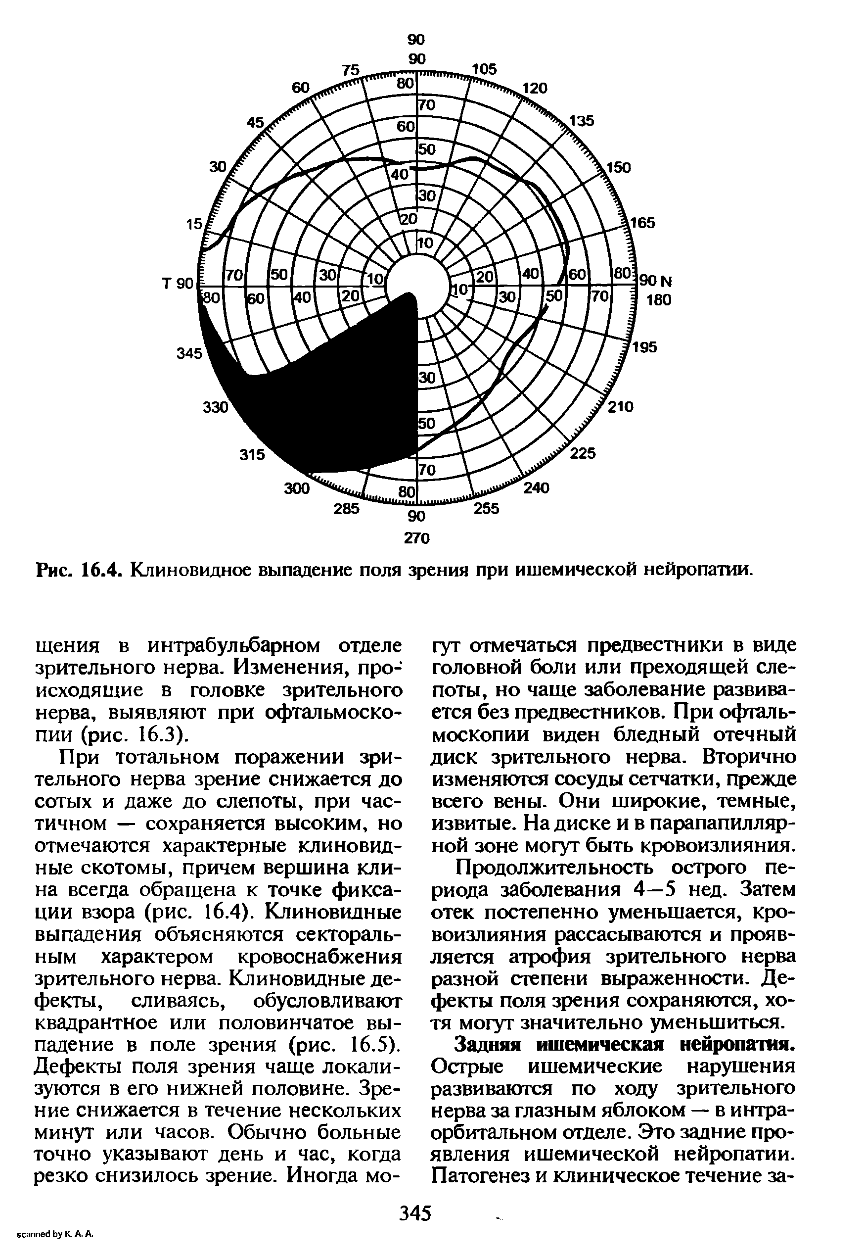 Рис. 16.4. Клиновидное выпадение поля зрения при ишемической нейропатии.