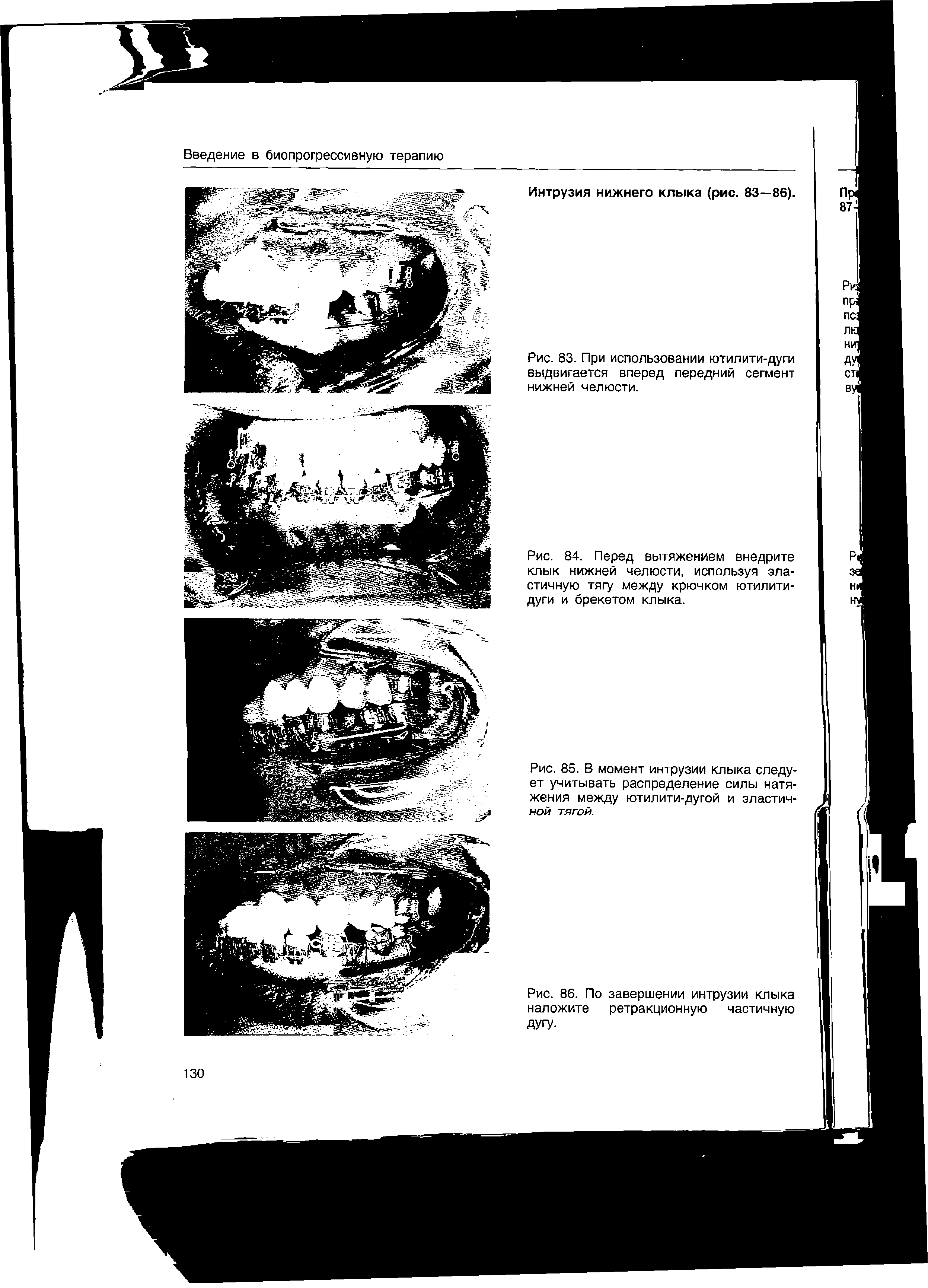 Рис. 86. По завершении интрузии клыка наложите ретракционную частичную ДУГУ-...