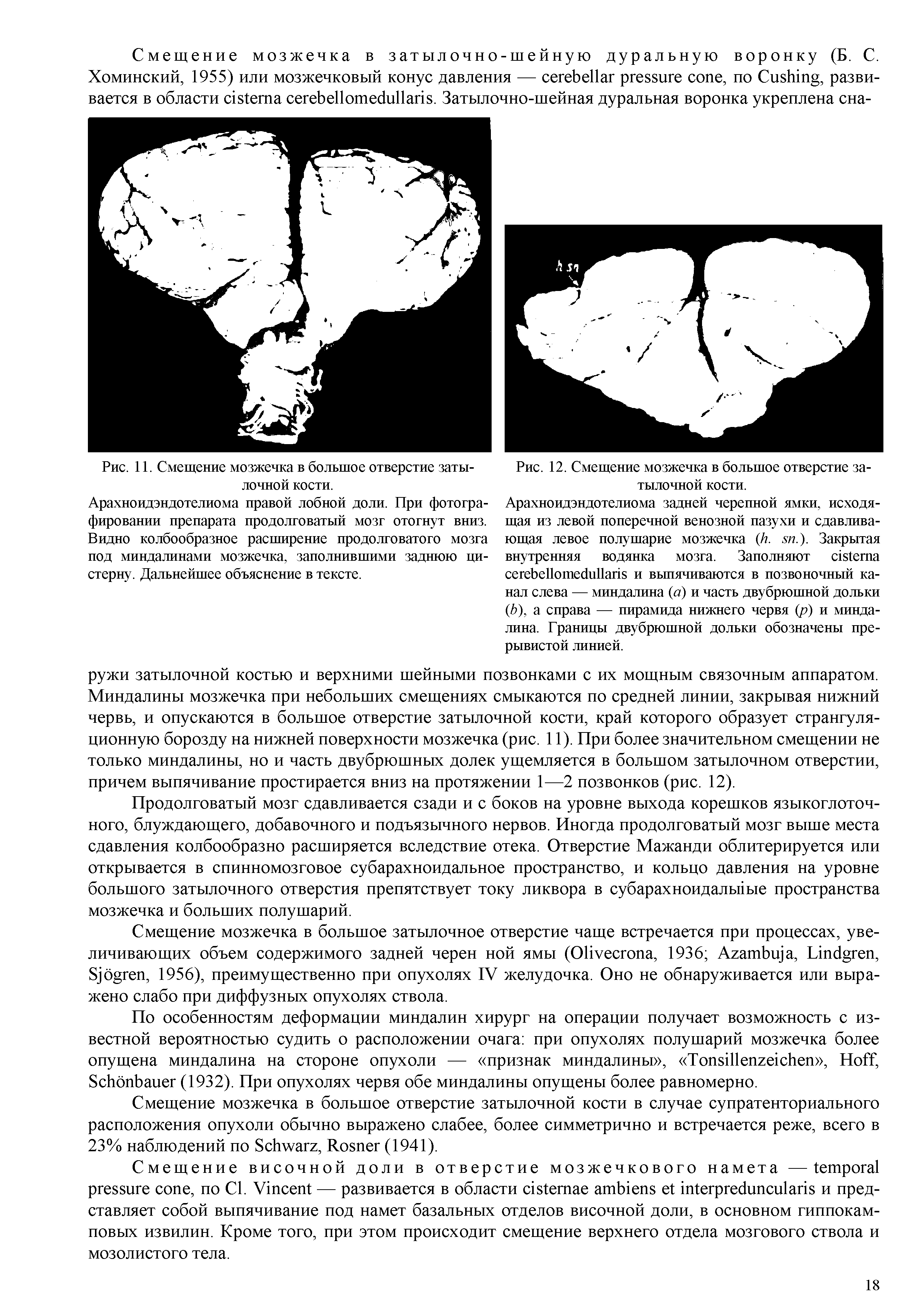 Рис. 11. Смещение мозжечка в большое отверстие затылочной кости.