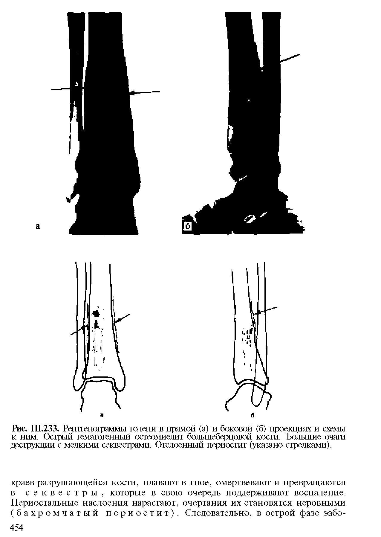 Рис. Ш.233. Рентгенограммы голени в прямой (а) и боковой (б) проекциях и схемы к ним. Острый гематогенный остеомиелит большеберцовой кости. Большие очаги деструкции с мелкими секвестрами. Отслоенный периостит (указано стрелками).
