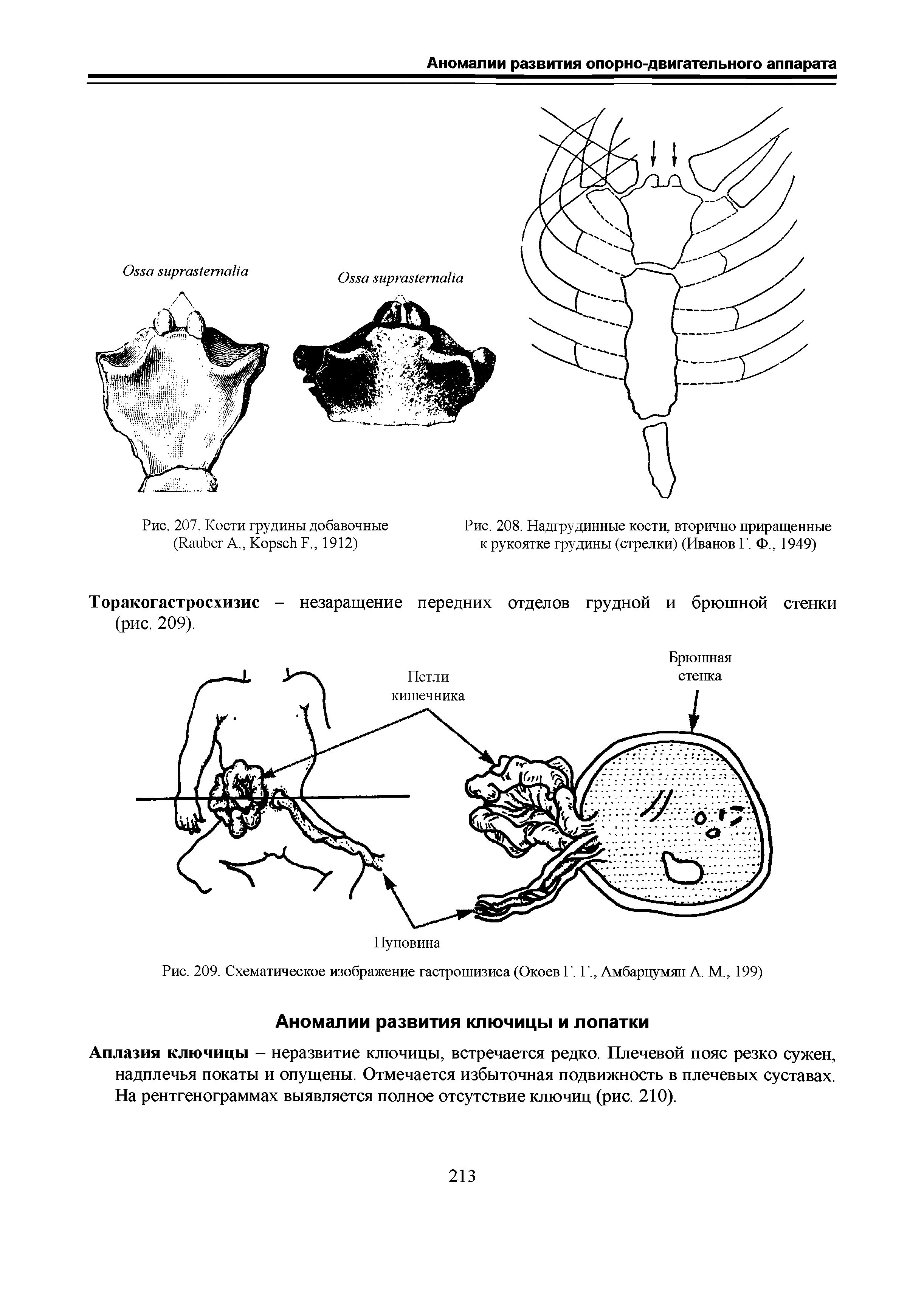 Рис. 208. Надгрудинные кости, вторично приращенные к рукоятке грудины (стрелки) (Иванов Г. Ф., 1949)...