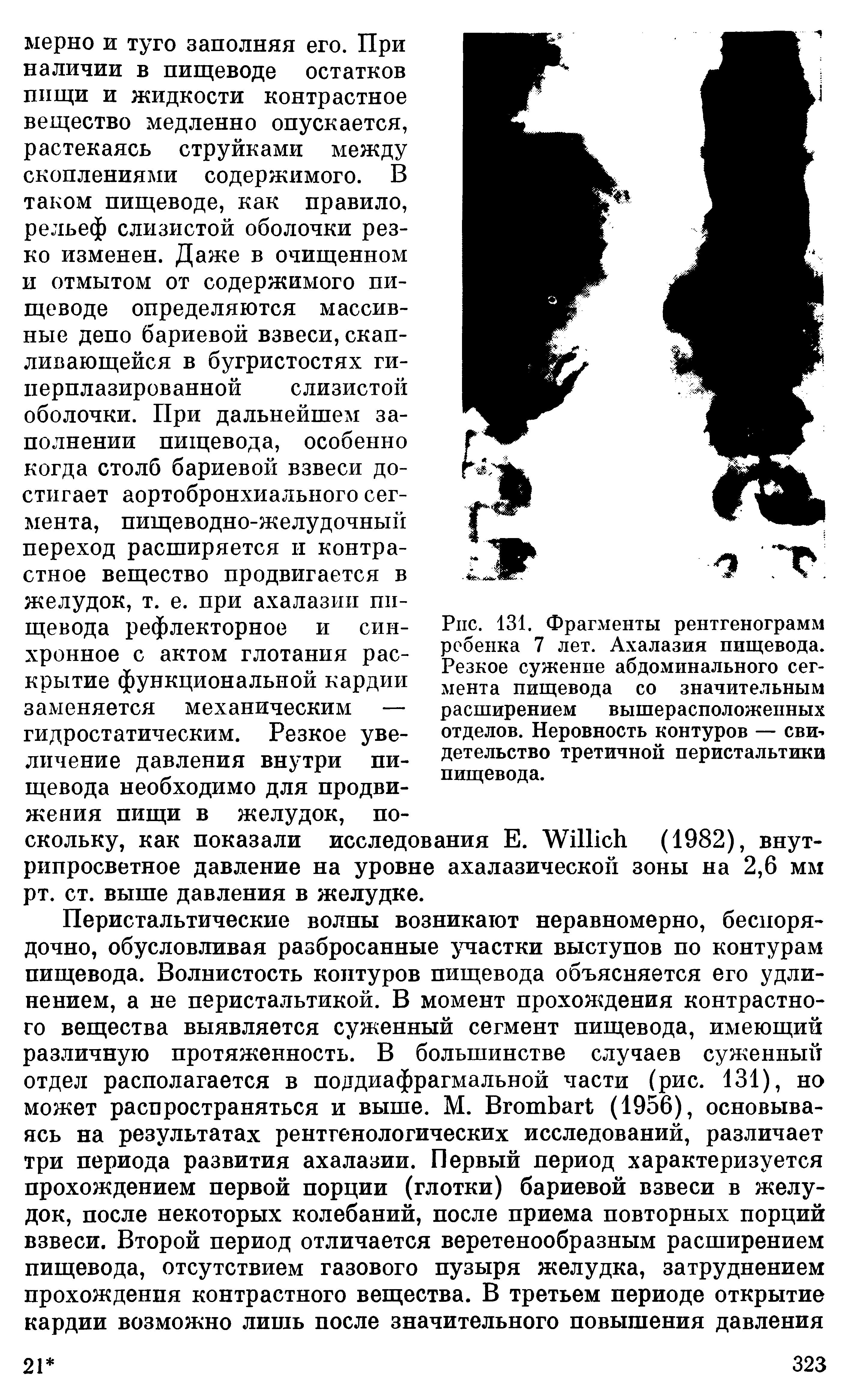 Рис. 131. Фрагменты рентгенограмм ребенка 7 лет. Ахалазия пищевода. Резкое сужение абдоминального сегмента пищевода со значительным расширением вышерасположенных отделов. Неровность контуров — свидетельство третичной перистальтики пищевода.