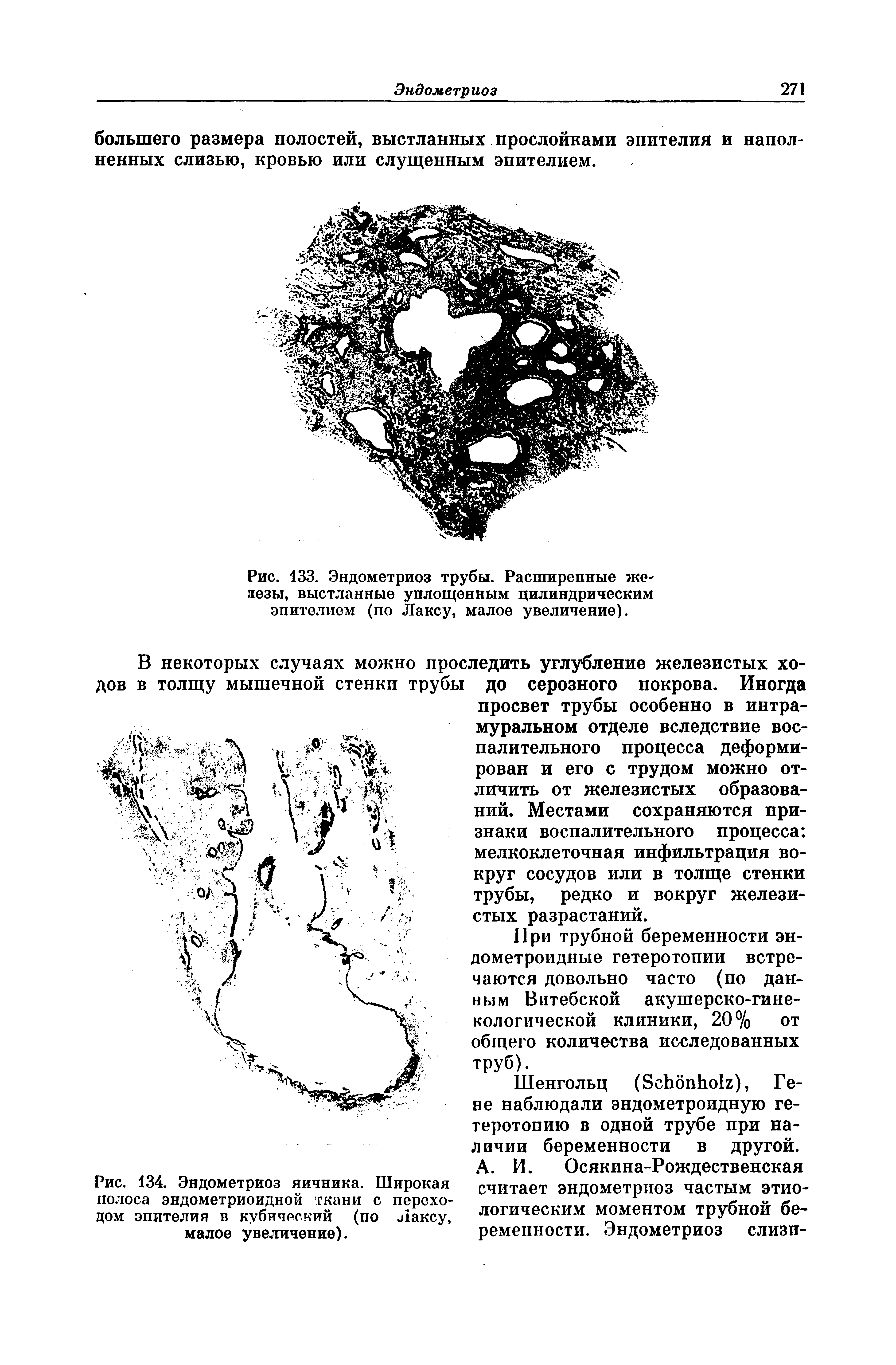 Рис. 134. Эндометриоз яичника. Широкая полоса эндометриоидной ткани с переходом эпителия в кубический (по Лаксу, малое увеличение).