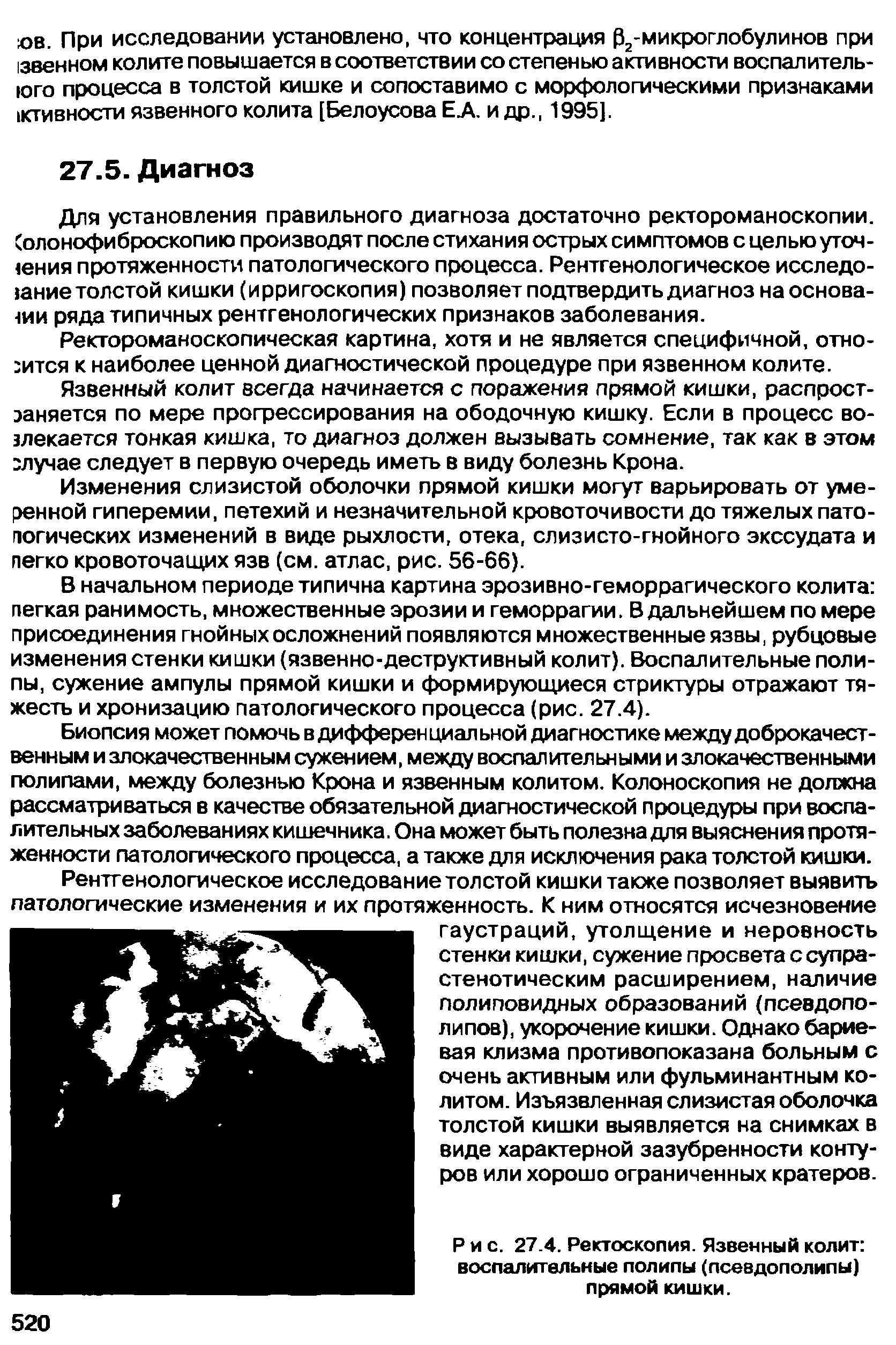 Рис. 27.4. Ректоскопия. Язвенный колит воспалительные полипы (псевдополипы) прямой кишки.