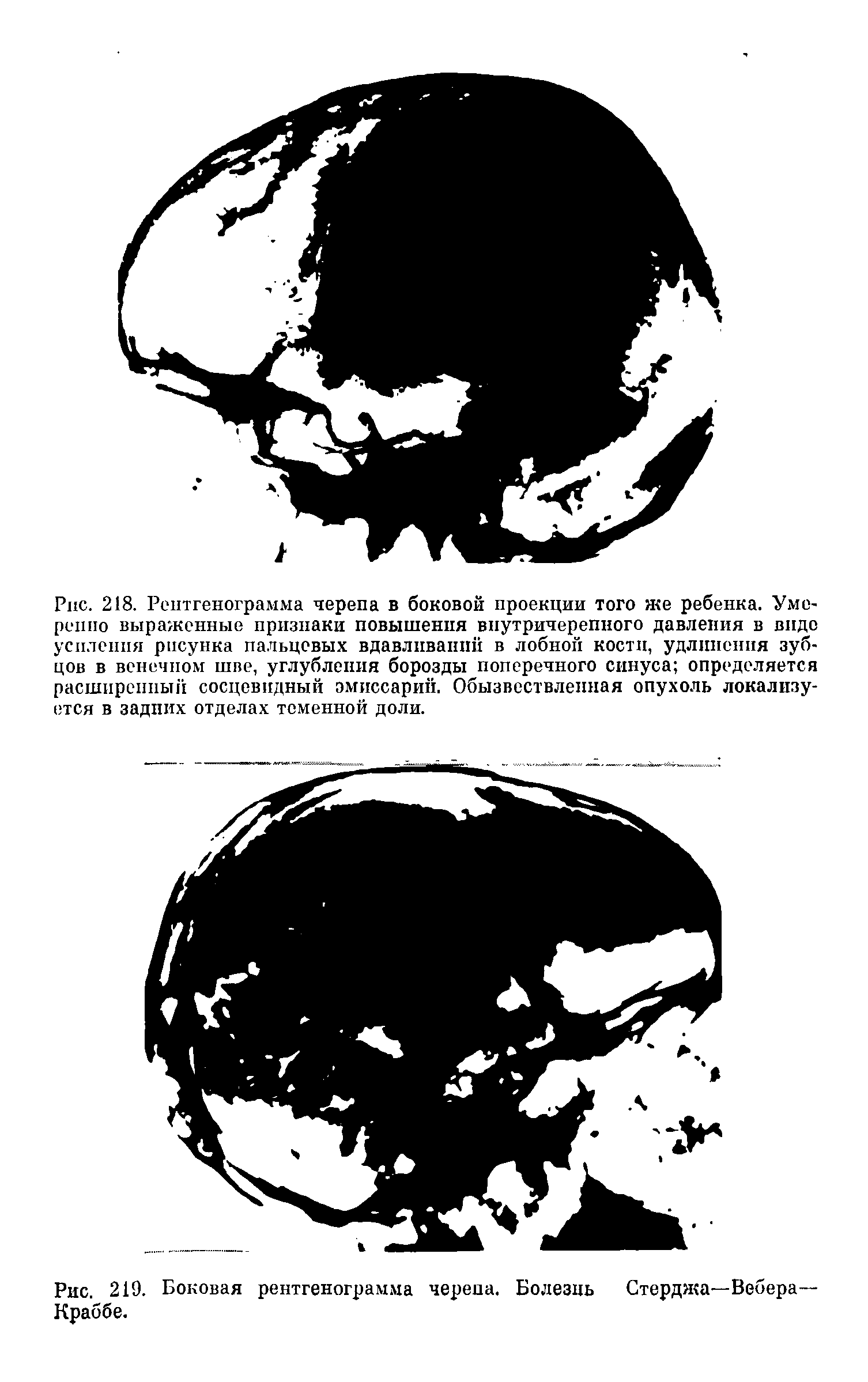 Рис. 219. Боковая рентгенограмма череда. Болезнь Стерджа—Вебера-Краббе.