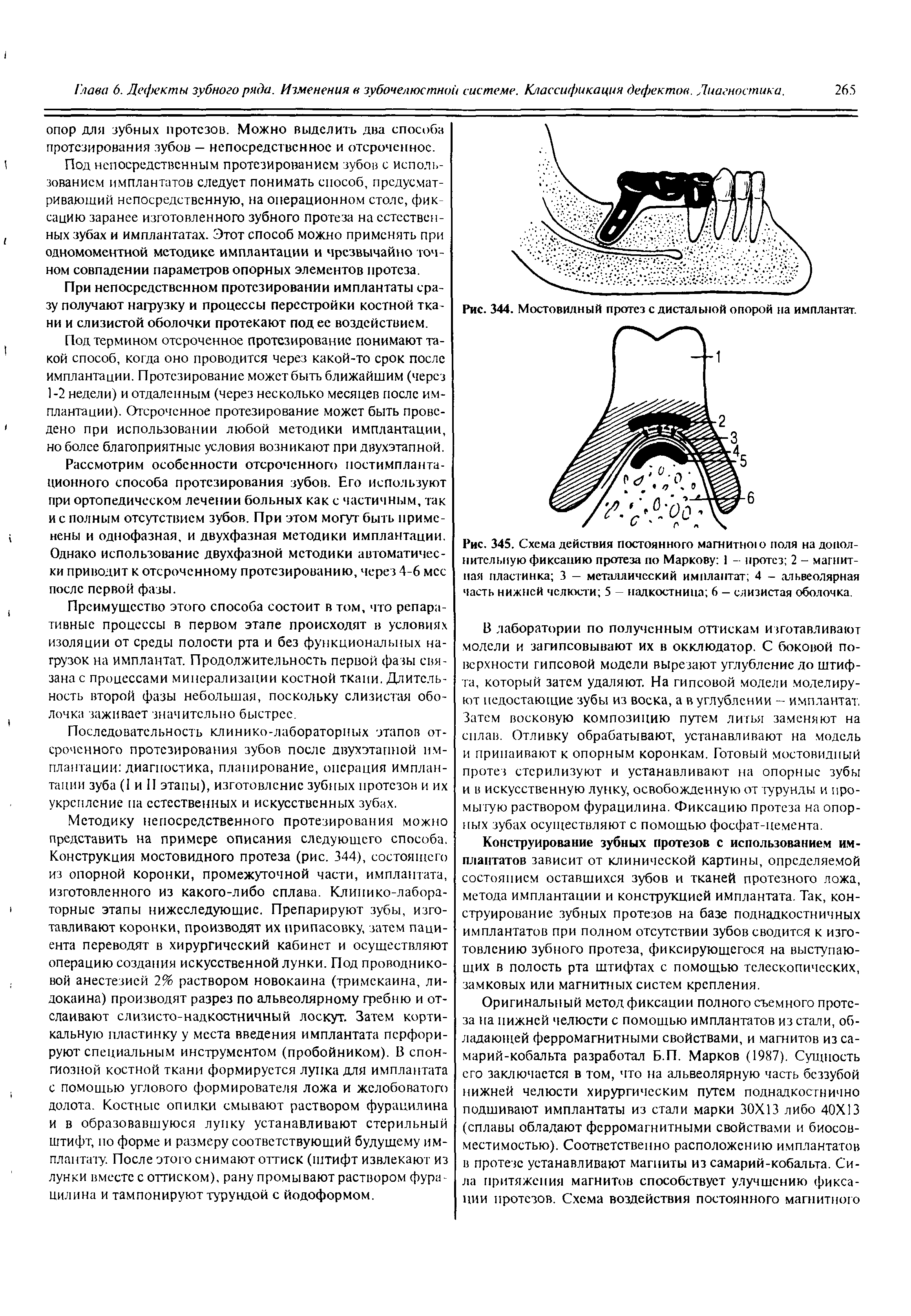 Рис. 345. Схема действия постоянного магнитною поля на дополнительную фиксацию протеза по Маркову 1 - протез 2 - магнитная пластинка 3 — металлический имплантат 4 - альвеолярная часть нижней челюсти 5 - надкостница 6 — слизистая оболочка.