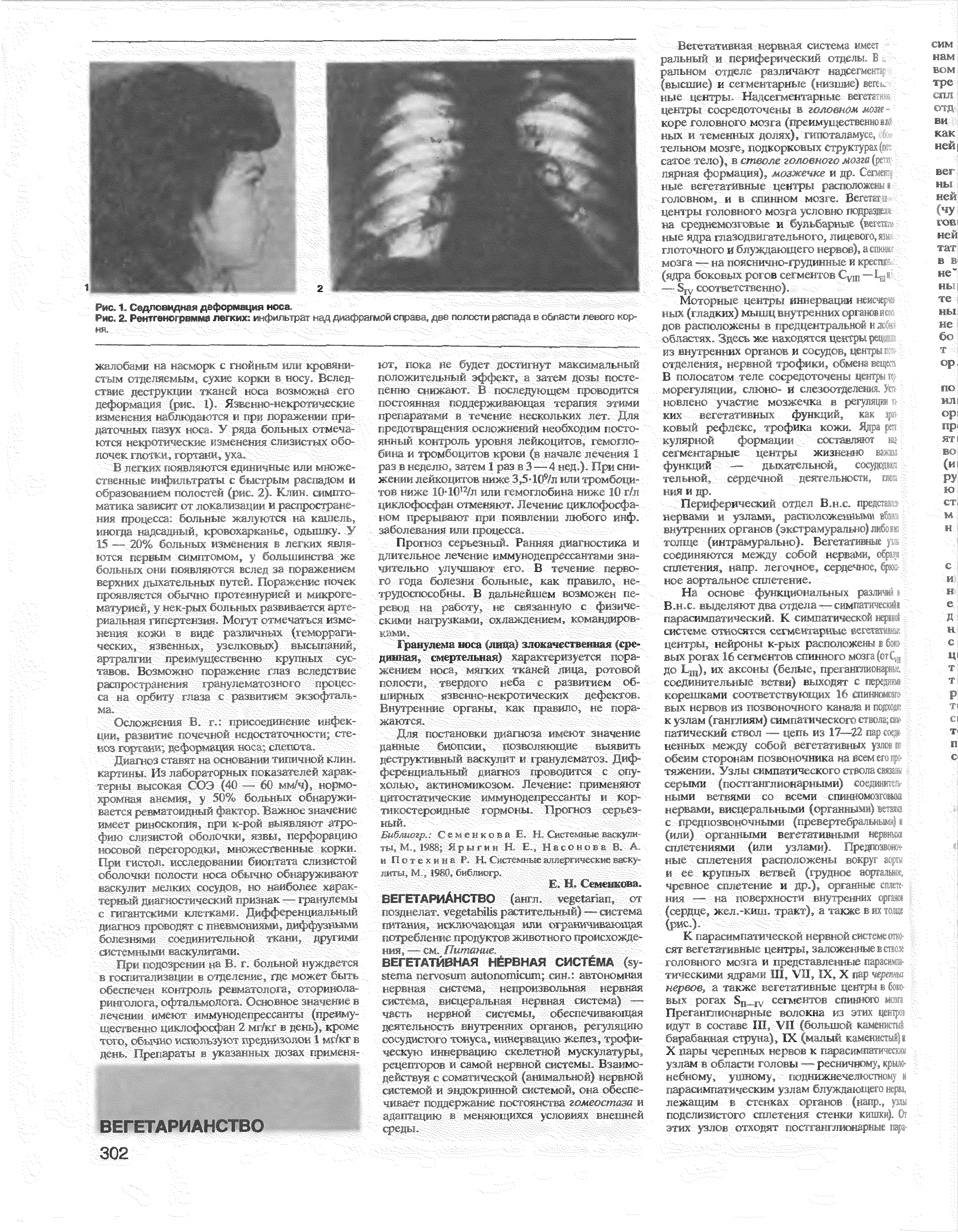 Рис. 2. Рентгенограмма легких инфильтрат над диафрагмой справа, две полости распада в области левого корня. /УУ 1 У У . ТО/.. . Д I//>/ ...