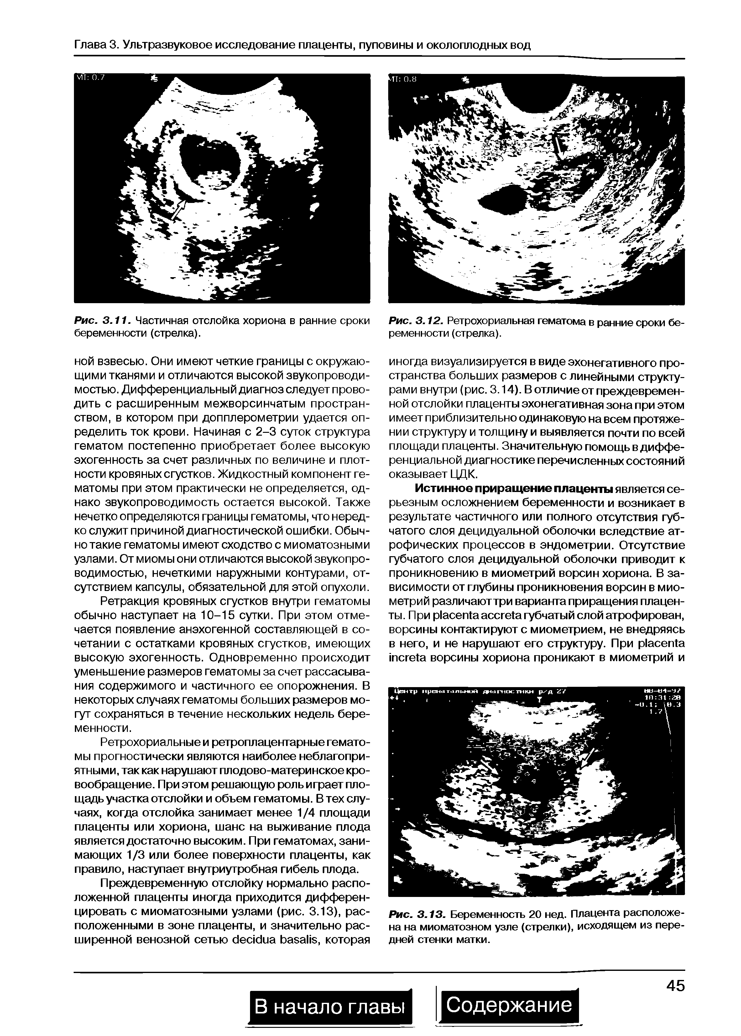 Рис. 3.12. Ретрохориальная гематома в ранние сроки беременности (стрелка).