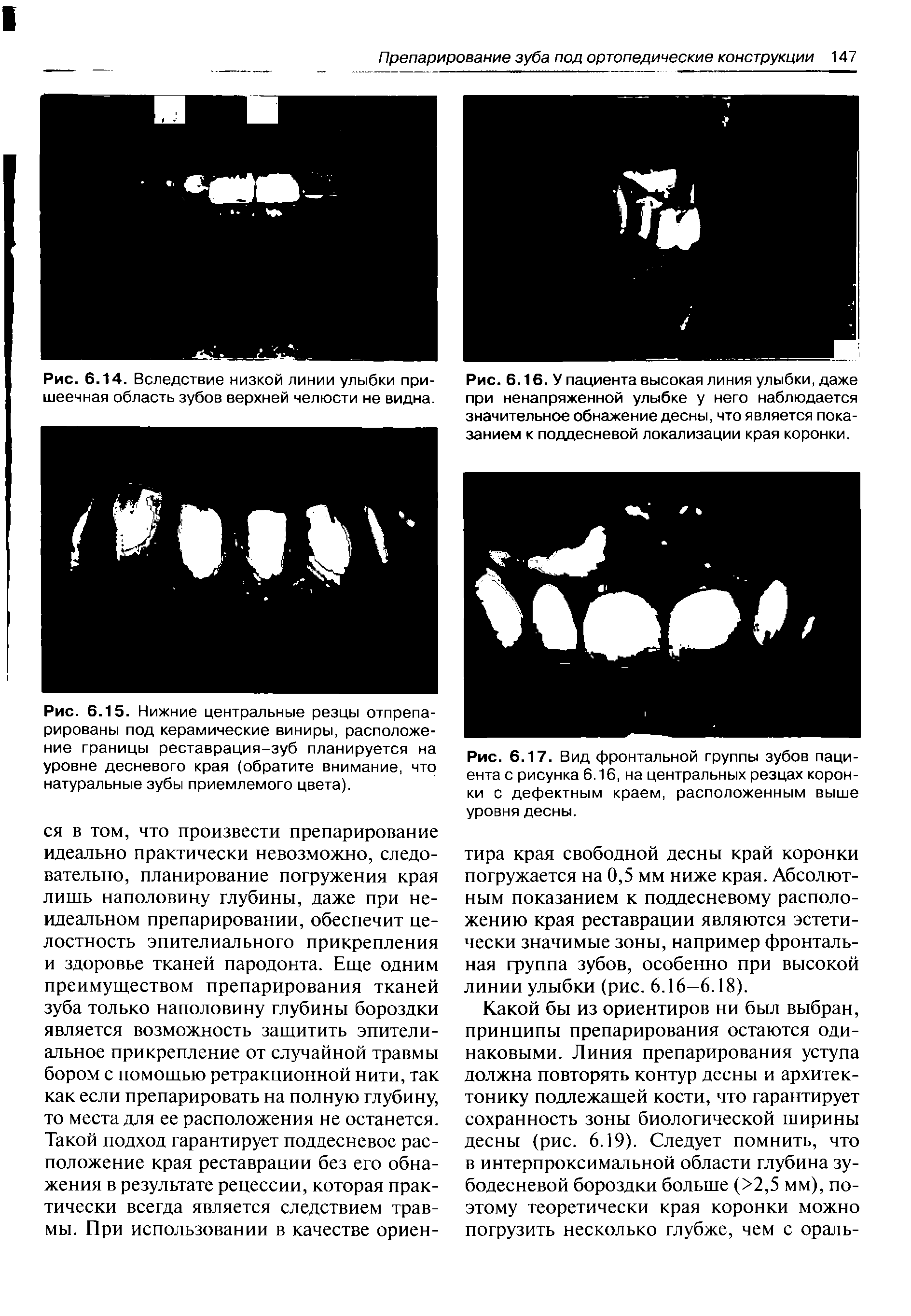 Рис. 6.17. Вид фронтальной группы зубов пациента с рисунка 6.16, на центральных резцах коронки с дефектным краем, расположенным выше уровня десны.