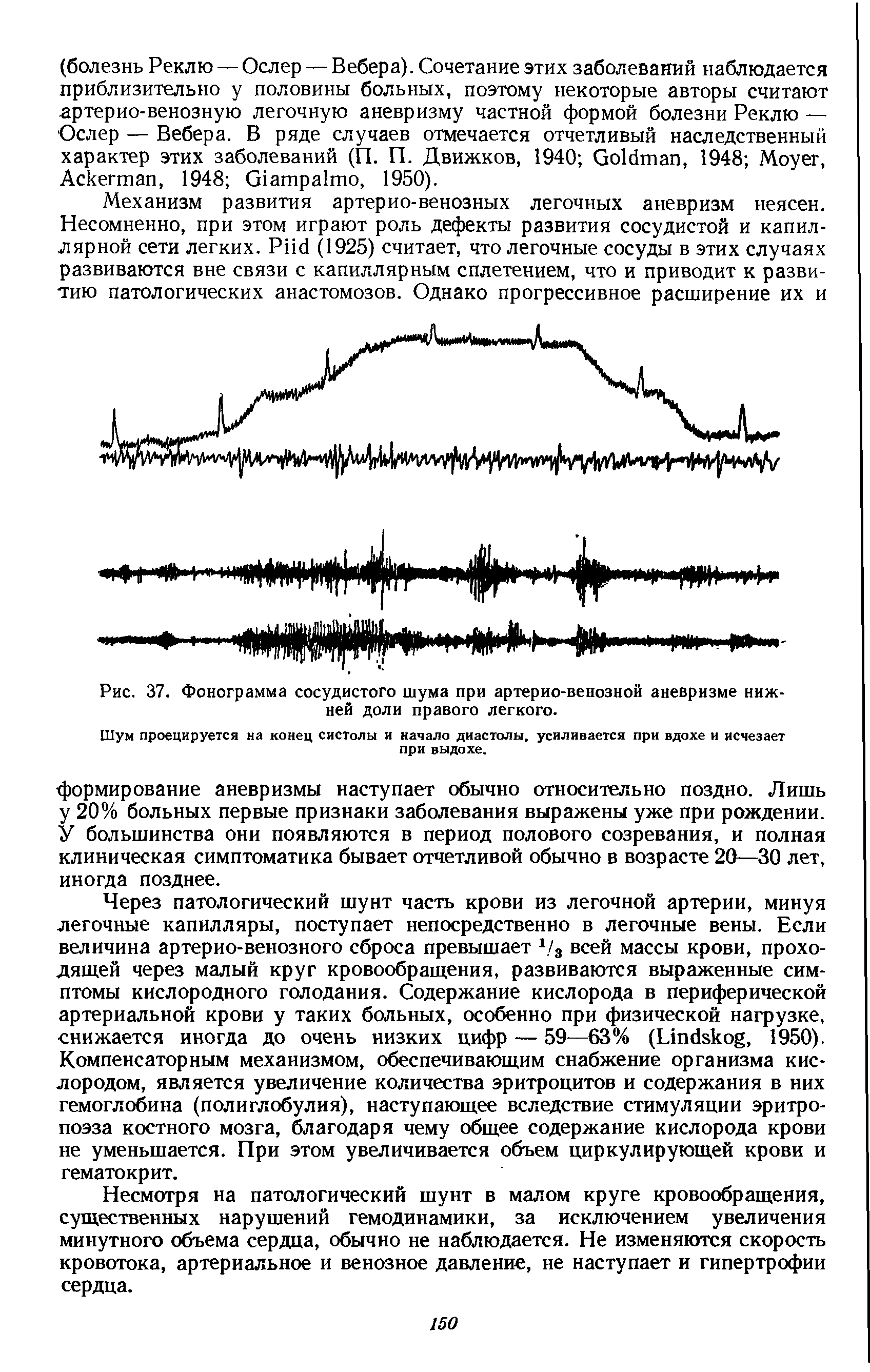 Рис. 37. Фонограмма сосудистого шума при артерио-венозной аневризме нижней доли правого легкого.