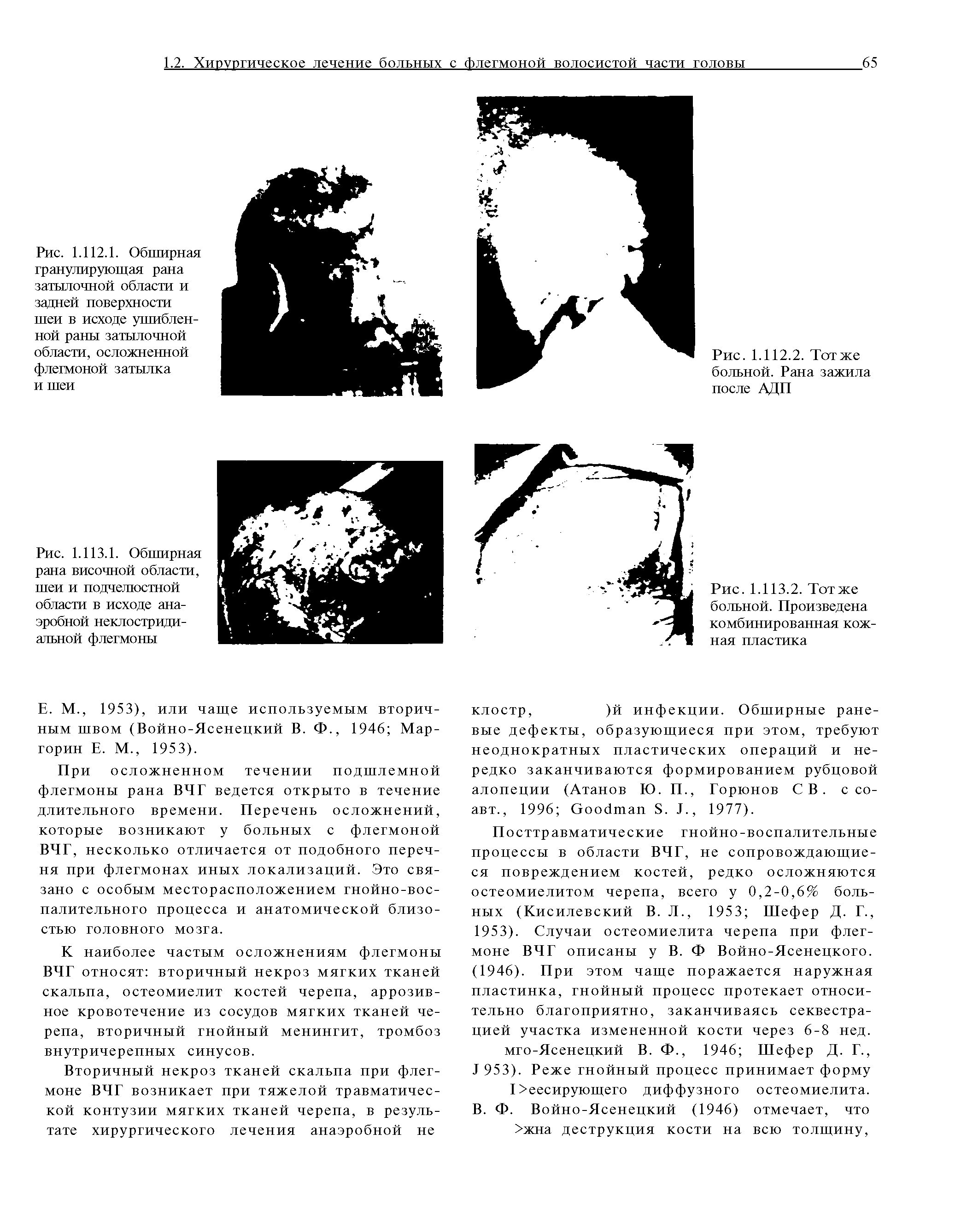 Рис. 1.113.1. Обширная рана височной области, шеи и подчелюстной области в исходе анаэробной неклостридиальной флегмоны...