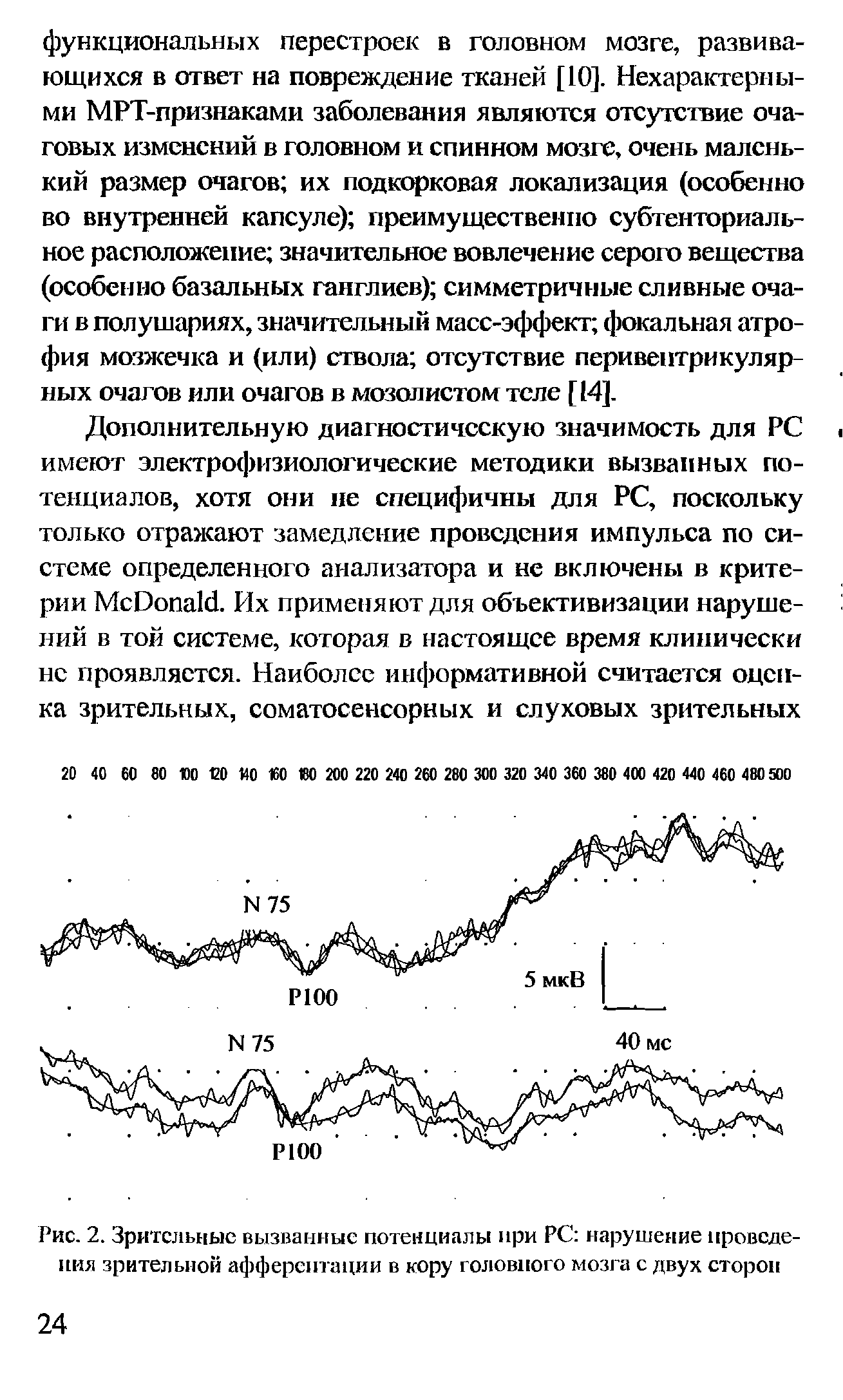 Рис. 2. Зрительные вызванные потенциалы при РС нарушение проведения зрительной афферентации в кору головного мозга с двух сторон...