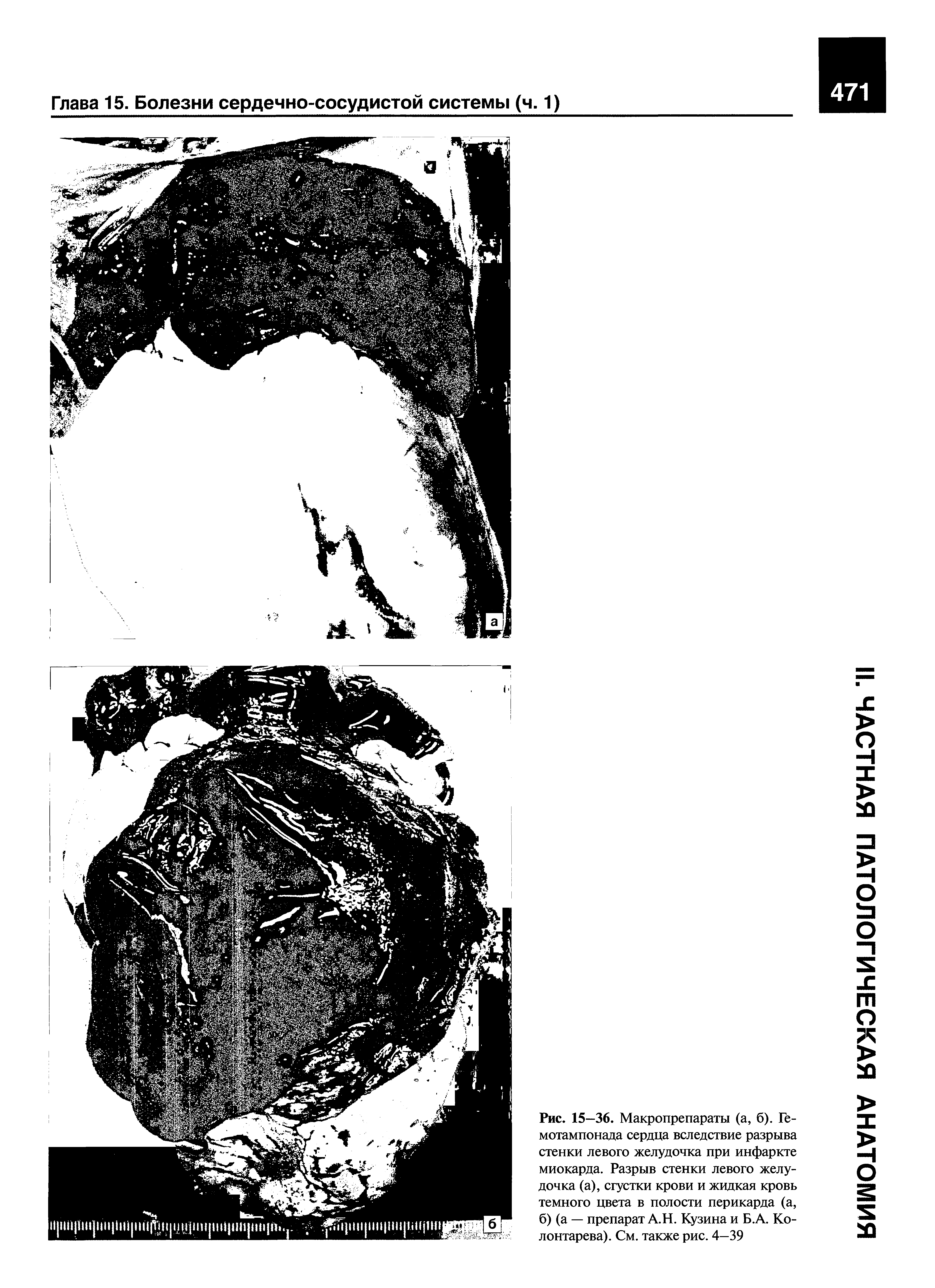 Рис. 15—36. Макропрепараты (а, б). Гемотампонада сердца вследствие разрыва стенки левого желудочка при инфаркте миокарда. Разрыв стенки левого желудочка (а), сгустки крови и жидкая кровь темного цвета в полости перикарда (а, б) (а — препарат А.Н. Кузина и Б.А. Ко-лонтарева). См. также рис. 4—39...