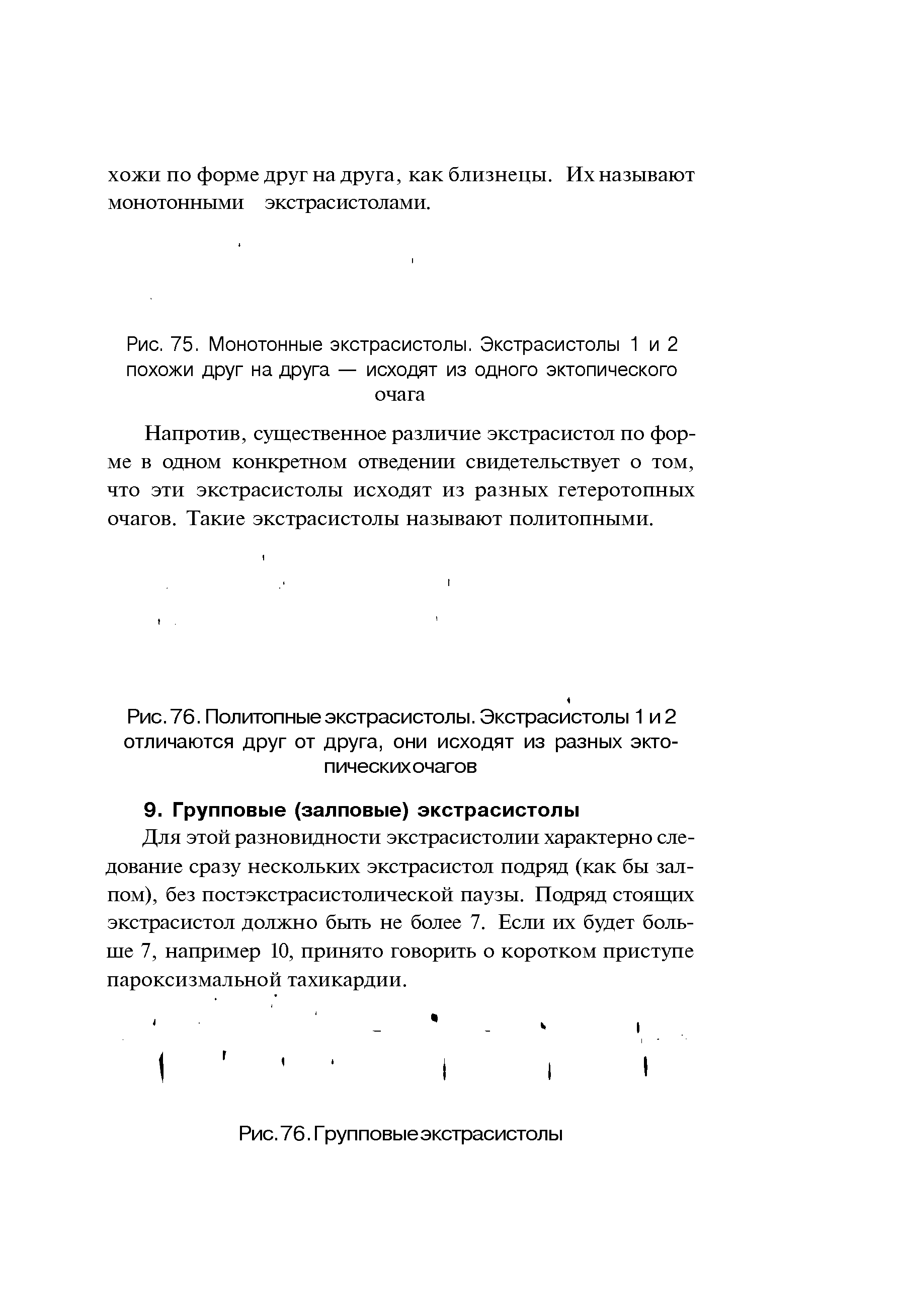 Рис. 75. Монотонные экстрасистолы. Экстрасистолы 1 и 2 похожи друг на друга — исходят из одного эктопического очага...