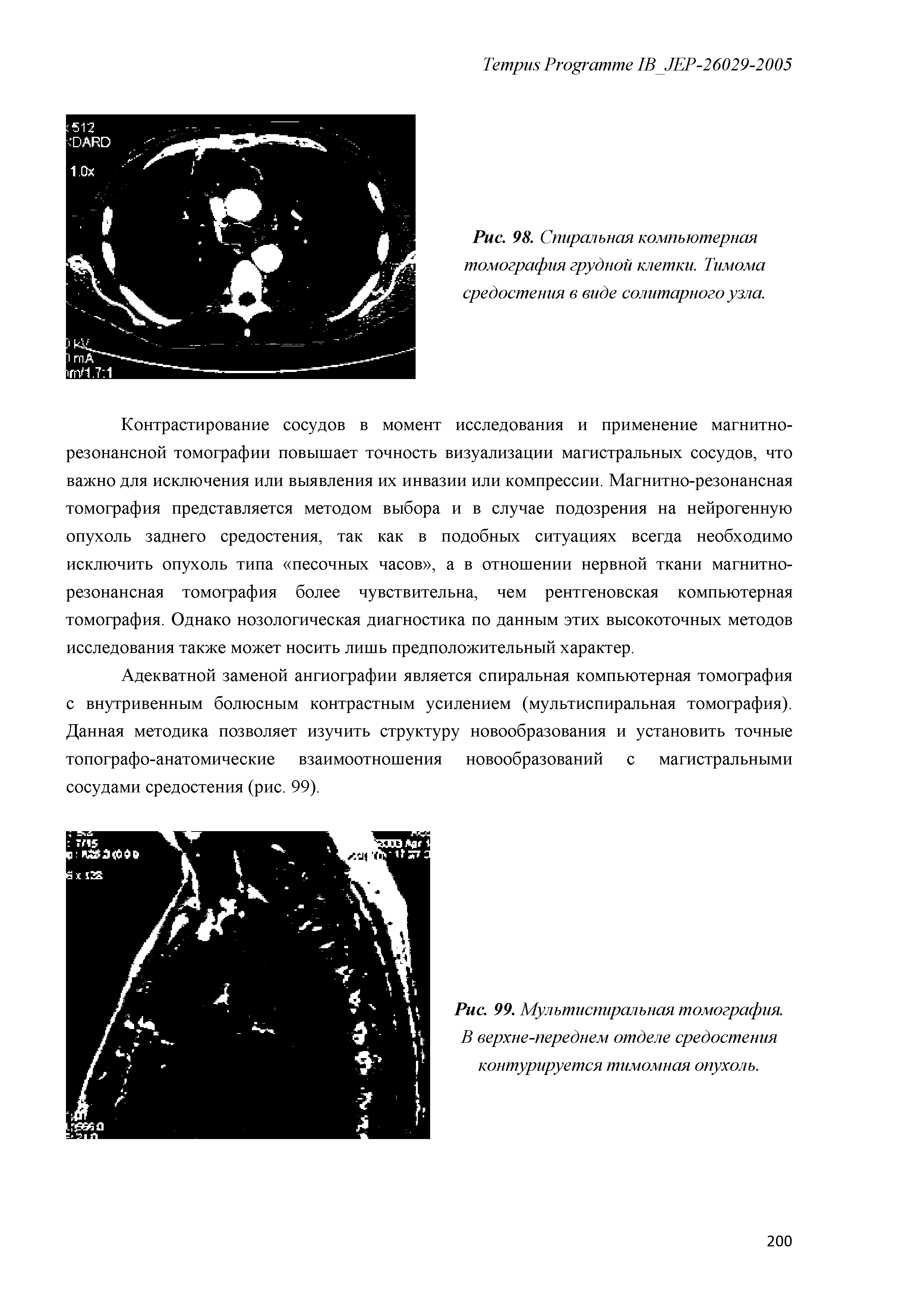 Рис. 98. Спиральная компьютерная томография грудной клетки. Тимома средостения в виде солитарного узла.