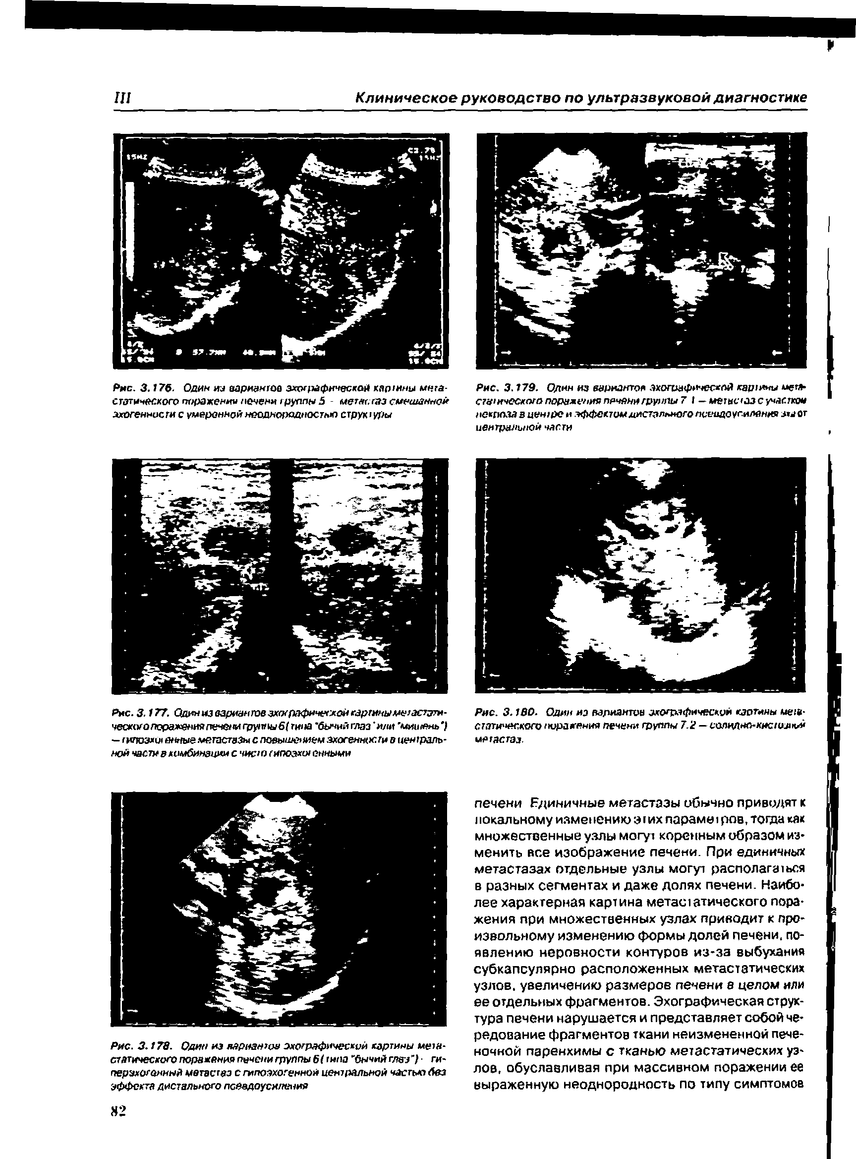 Рис. 3.180. Один из вариантов эхографической кзотины мел-статического поранения печени группы 7.2 — сопилно-кис1имк>ы метастаз.
