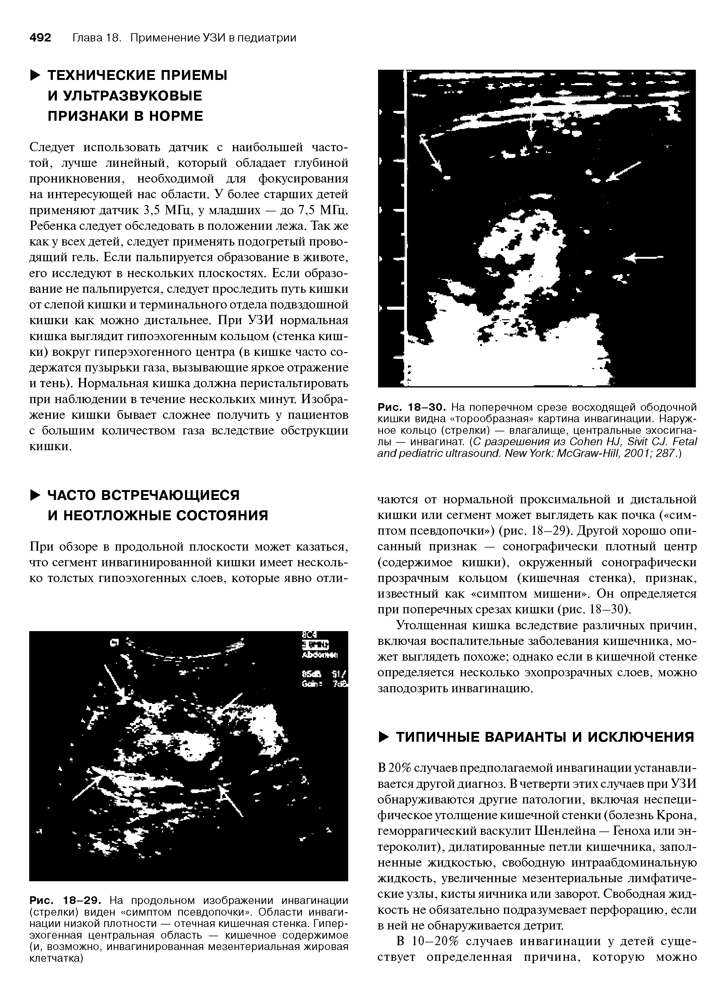 Рис. 18-30. На поперечном срезе восходящей ободочной кишки видна торообразная картина инвагинации. Наружное кольцо (стрелки) — влагалище, центральные эхосигна-лы — инвагинат. (С разрешения из C HJ, S CJ. F . N Y M G -H , 2001 287.)...