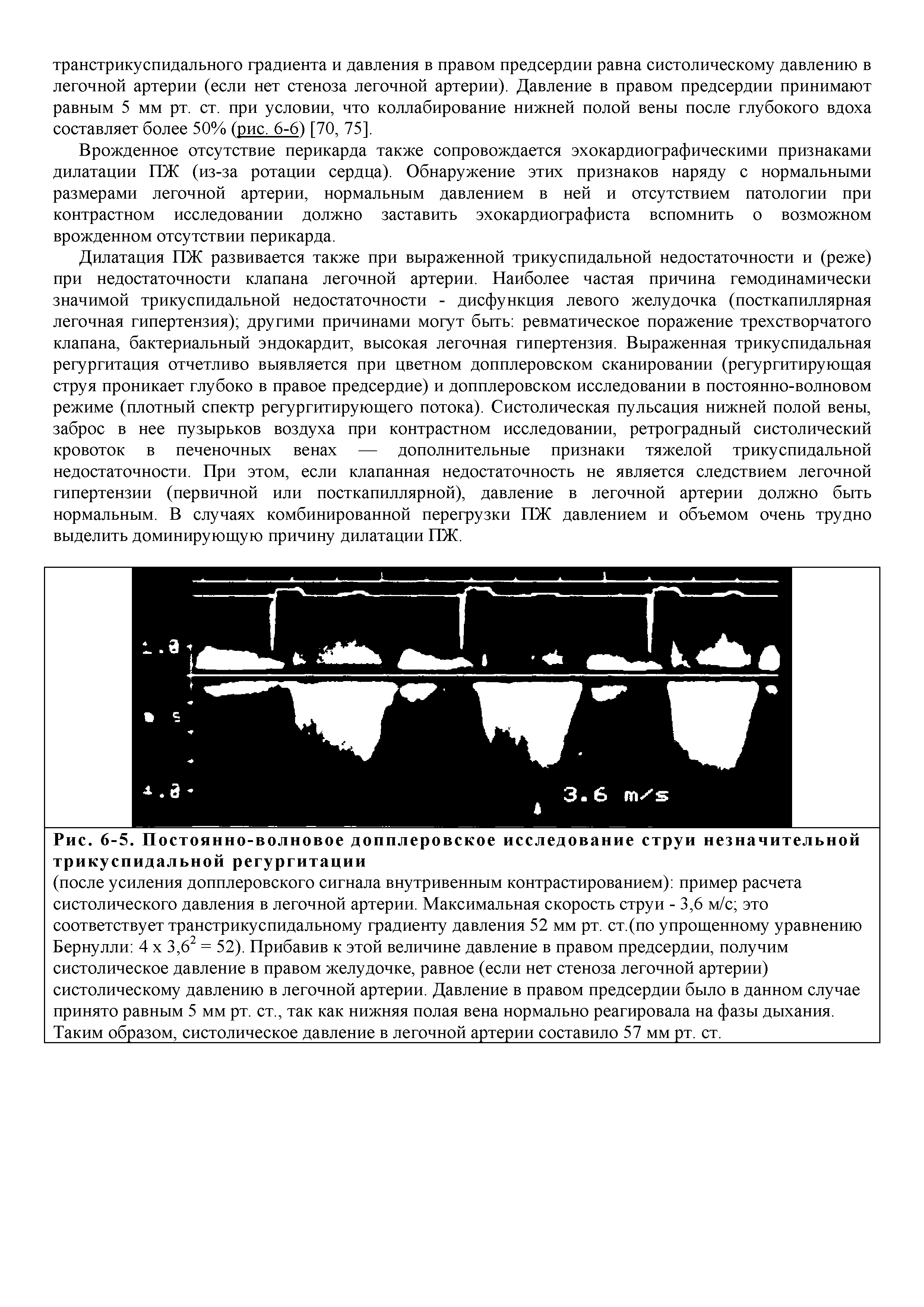 Рис. 6-5. Постоянно-волновое допплеровское исследование струи незначительной трикуспидальной регургитации...