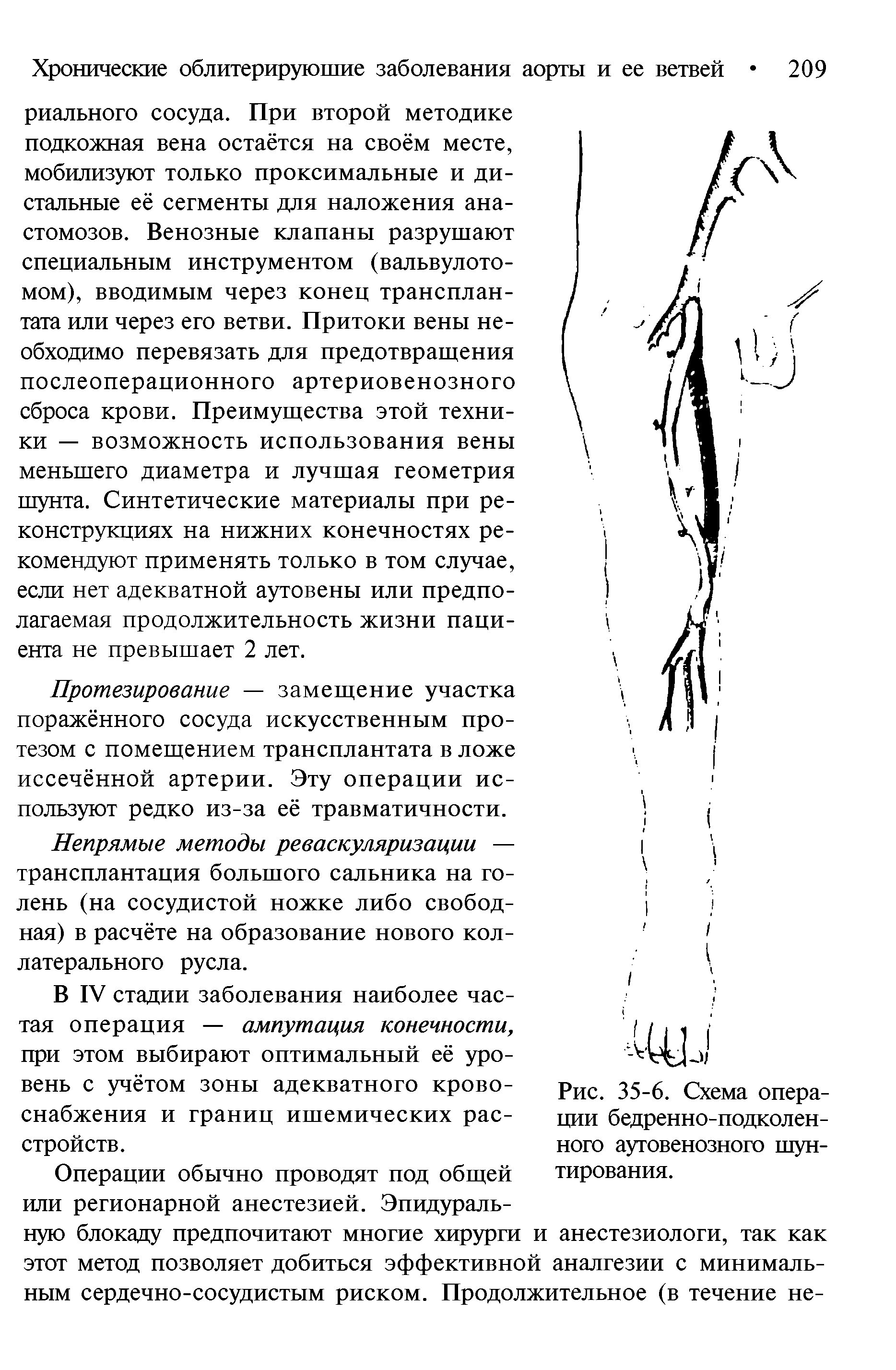 Рис. 35-6. Схема операции бедренно-подколенного аутовенозного шунтирования.