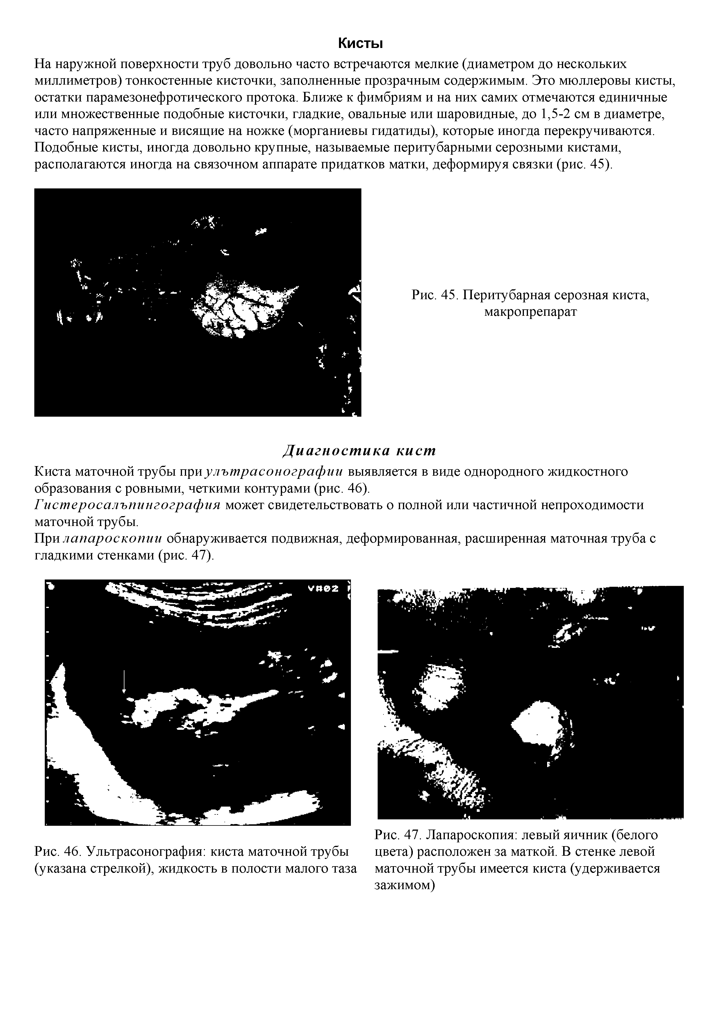 Рис. 46. Ультрасонография киста маточной трубы (указана стрелкой), жидкость в полости малого таза...