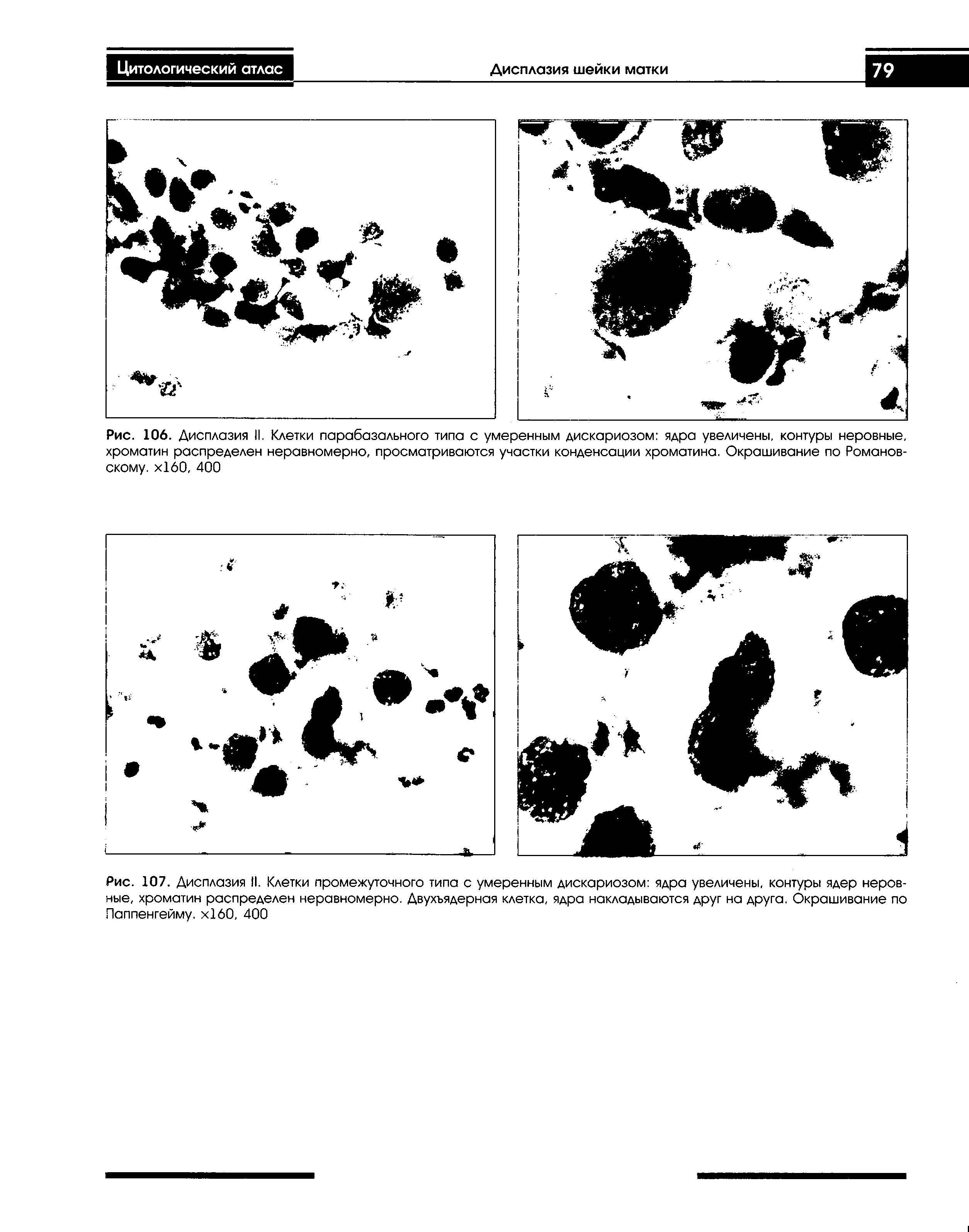 Рис. 107. Дисплазия II. Клетки промежуточного типа с умеренным дискариозом ядра увеличены, контуры ядер неровные, хроматин распределен неравномерно. Двухъядерная клетка, ядра накладываются друг на друга. Окрашивание по Паппенгейму. х 60, 400...