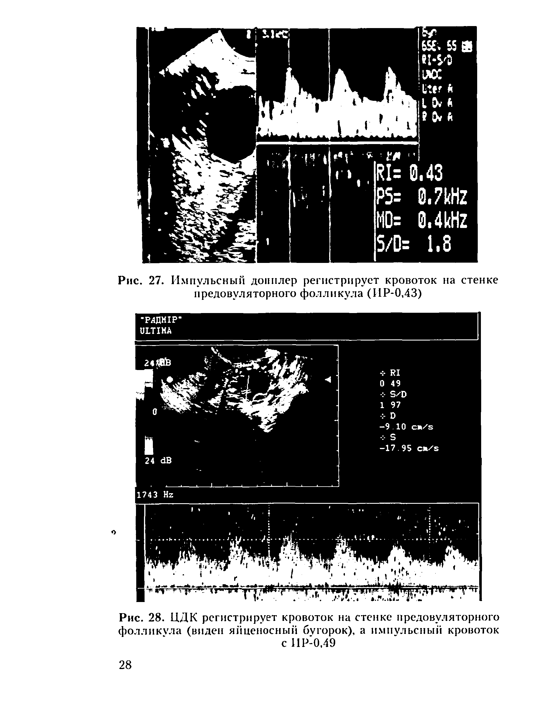 Рис. 28. ЦДК регистрирует кровоток на стенке предовуляторного фолликула (виден яйценосный бугорок), а импульсный кровоток с ИР-0,49...