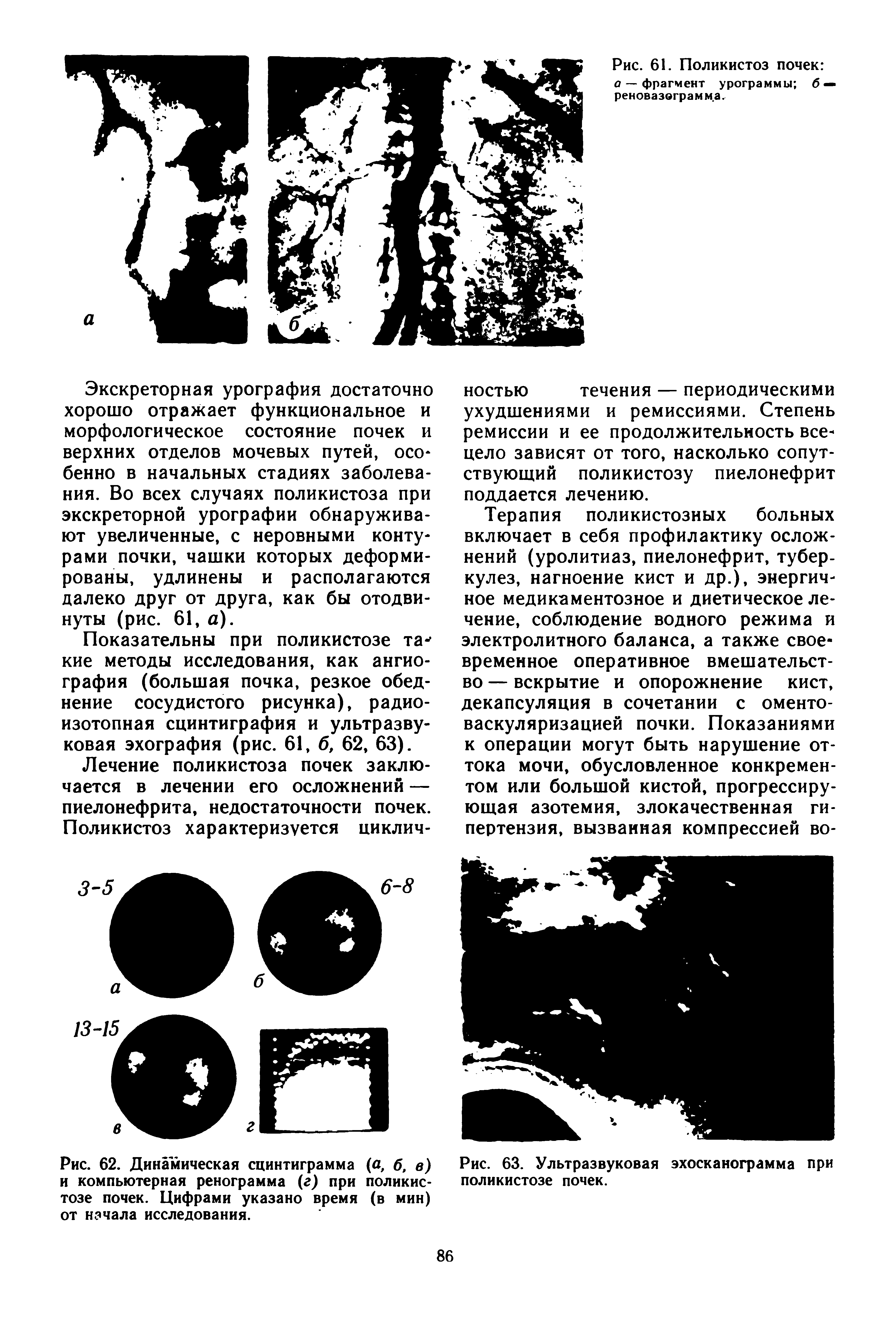 Рис. 62. Динамическая сцинтиграмма (а, б, в) и компьютерная ренограмма (г) при поликистозе почек. Цифрами указано время (в мин) от начала исследования.