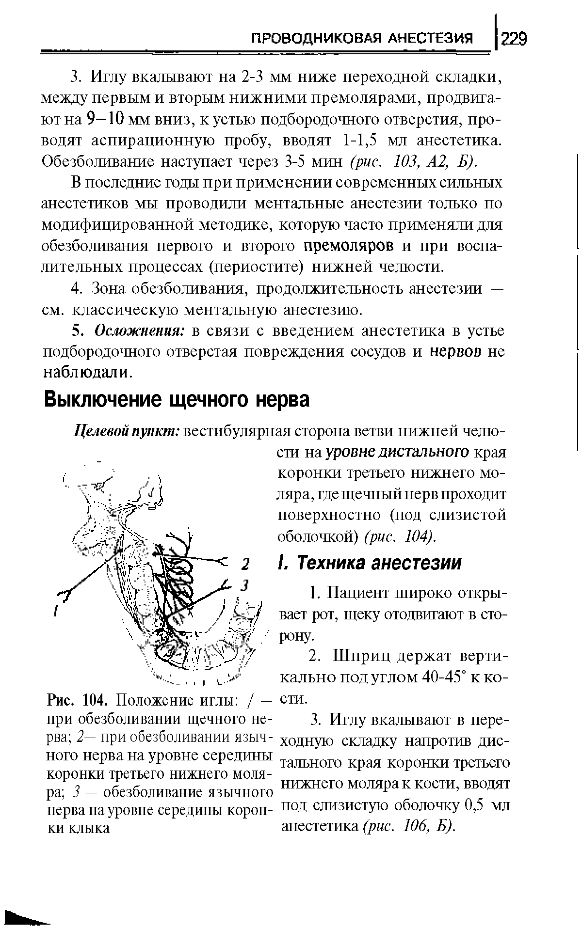 Рис. 104. Положение иглы / — при обезболивании щечного нерва 2— при обезболивании язычного нерва на уровне середины коронки третьего нижнего моляра 3 — обезболивание язычного нерва на уровне середины коронки клыка...