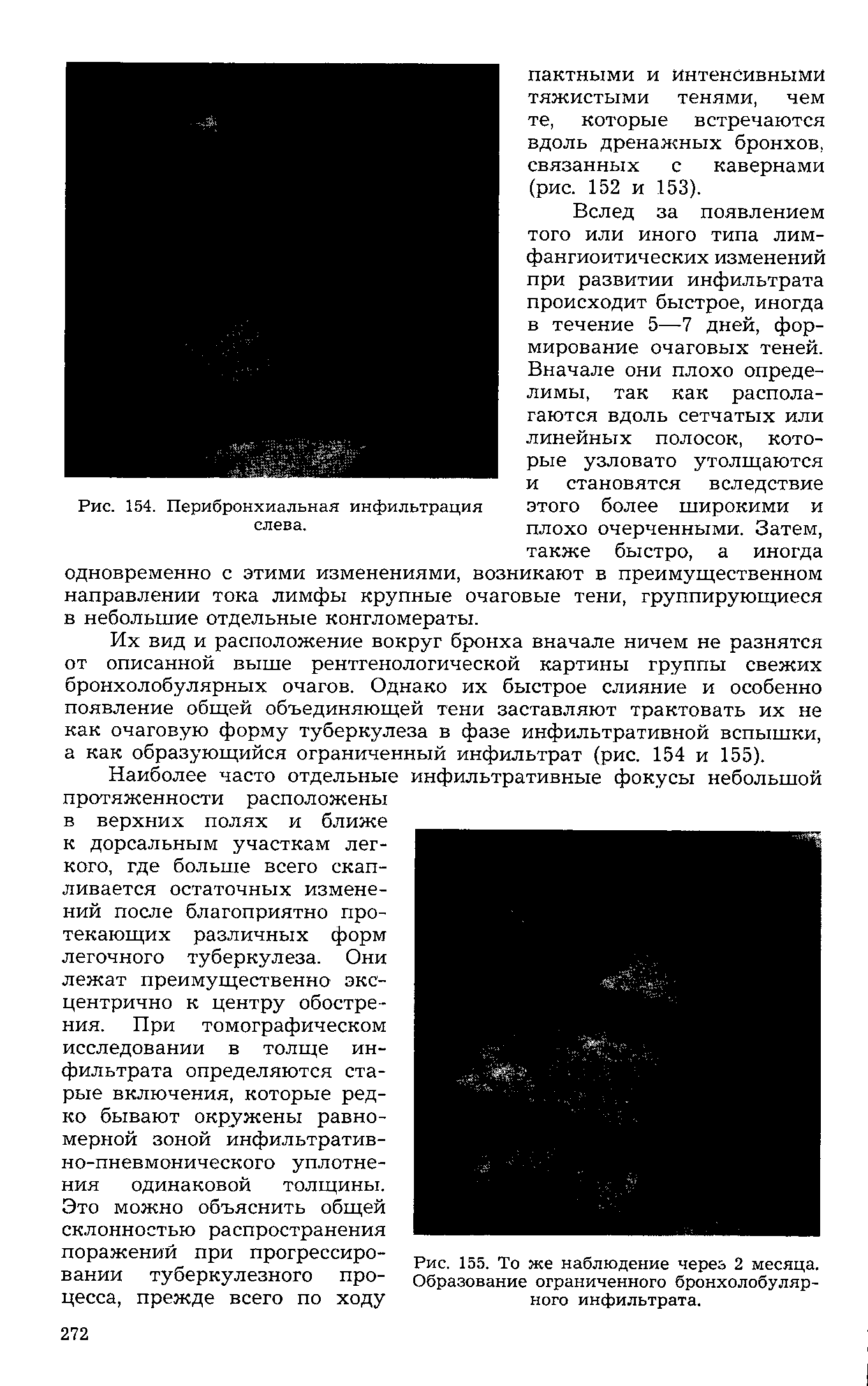 Рис. 155. То же наблюдение через 2 месяца. Образование ограниченного бронхолобулярного инфильтрата.