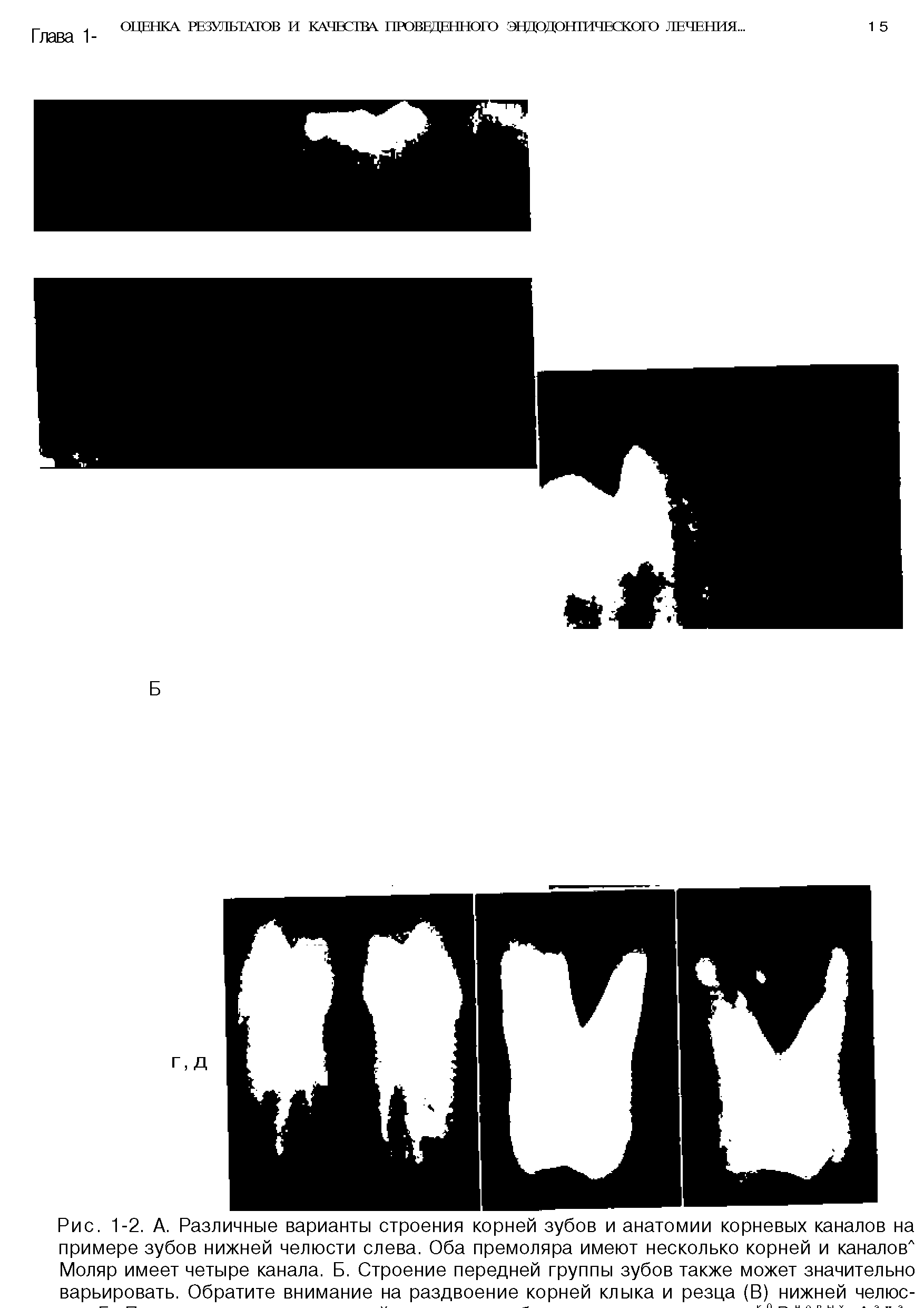 Рис. 1-2. А. Различные варианты строения корней зубов и анатомии корневых каналов на примере зубов нижней челюсти слева. Оба премоляра имеют несколько корней и каналов" Моляр имеет четыре канала. Б. Строение передней группы зубов также может значительно варьировать. Обратите внимание на раздвоение корней клыка и резца (В) нижней челюс-...