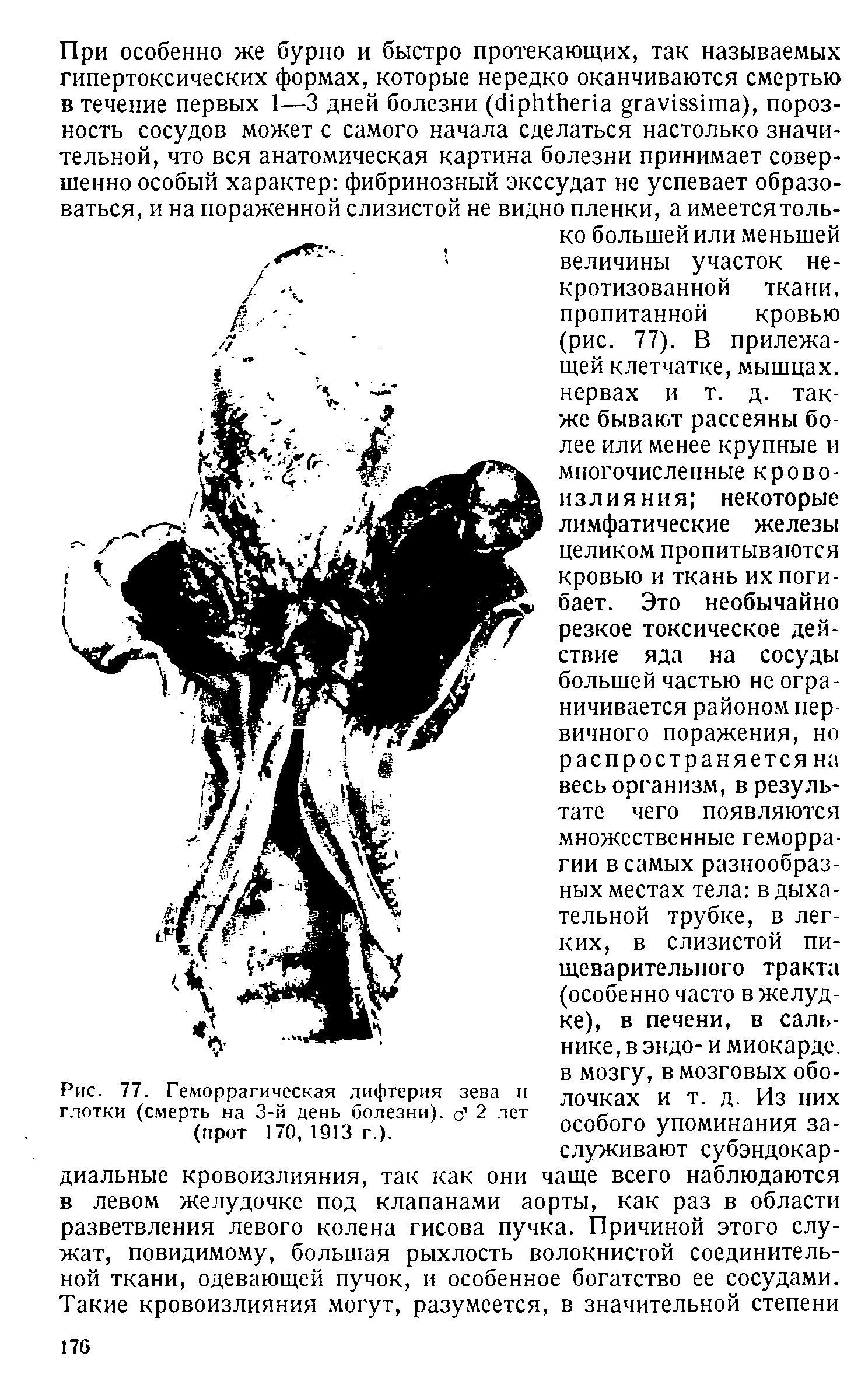 Рис. 77. Геморрагическая дифтерия зева и глотки (смерть на 3-й день болезни), о 2 лет (прот 170, 1913 г.).