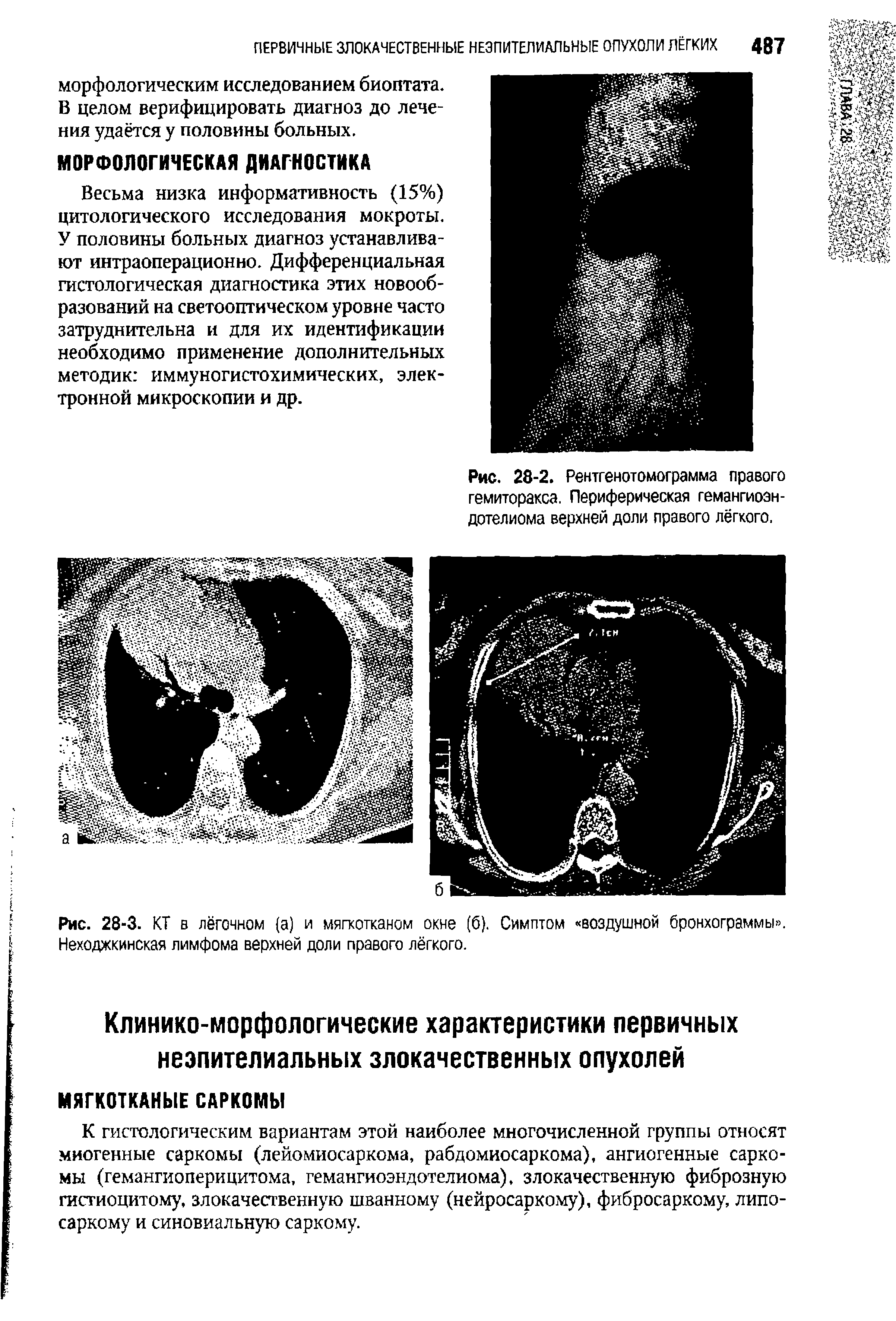 Рис. 28-2. Рентгенотомограмма правого гемиторакса. Периферическая гемангиоэндотелиома верхней доли правого лёгкого.