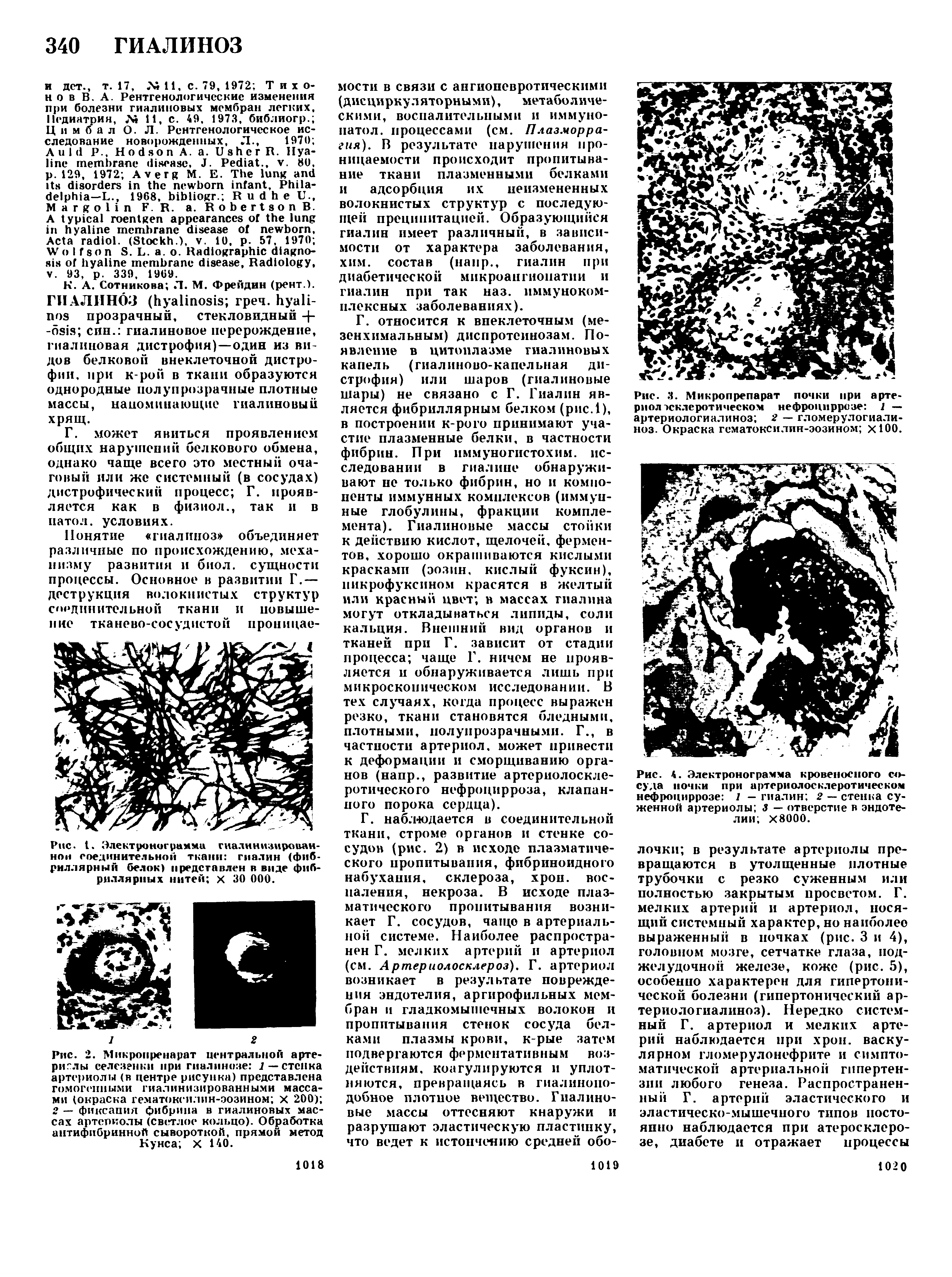 Рис. 1. Электронограмми гиалннизирован-нои соединительной ткани гиалин (фибриллярный белок) представлен в виде фибриллярных нитей х 30 000.