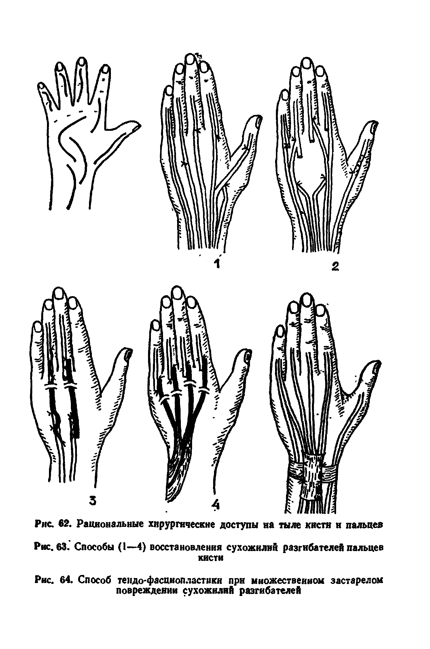 Рис. 63. Способы (I—4) восстановления сухожилий разгибателей пальцев кисти...