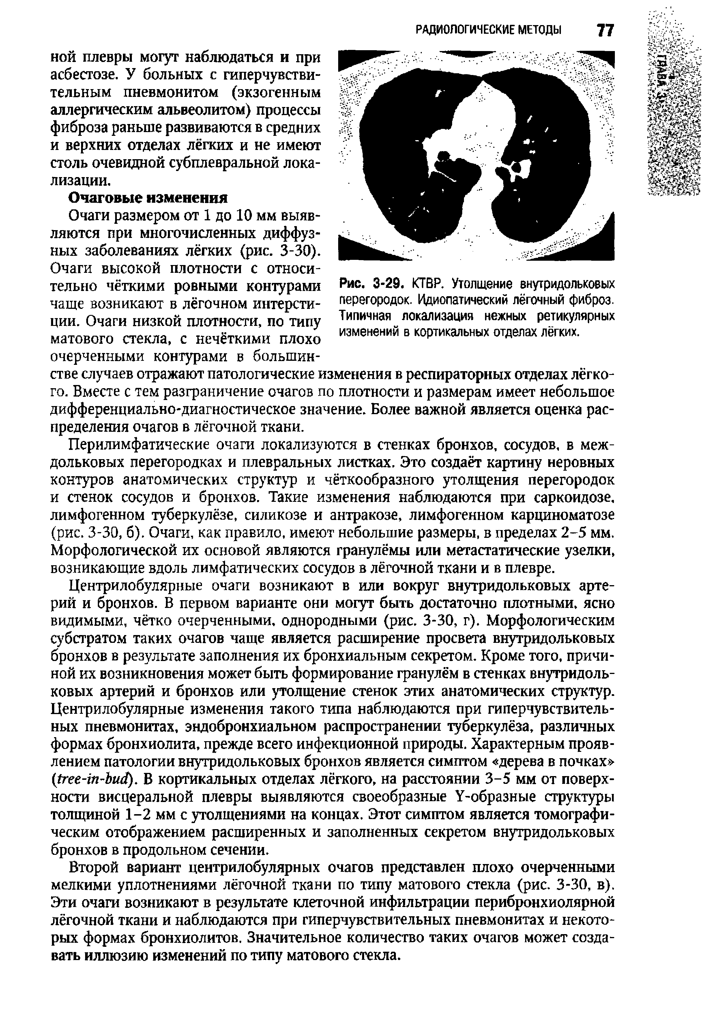 Рис. 3-29. КТВР. Утолщение внутридольковых перегородок. Идиопатический лёгочный фиброз. Типичная локализация нежных ретикулярных изменений в кортикальных отделах лёгких.