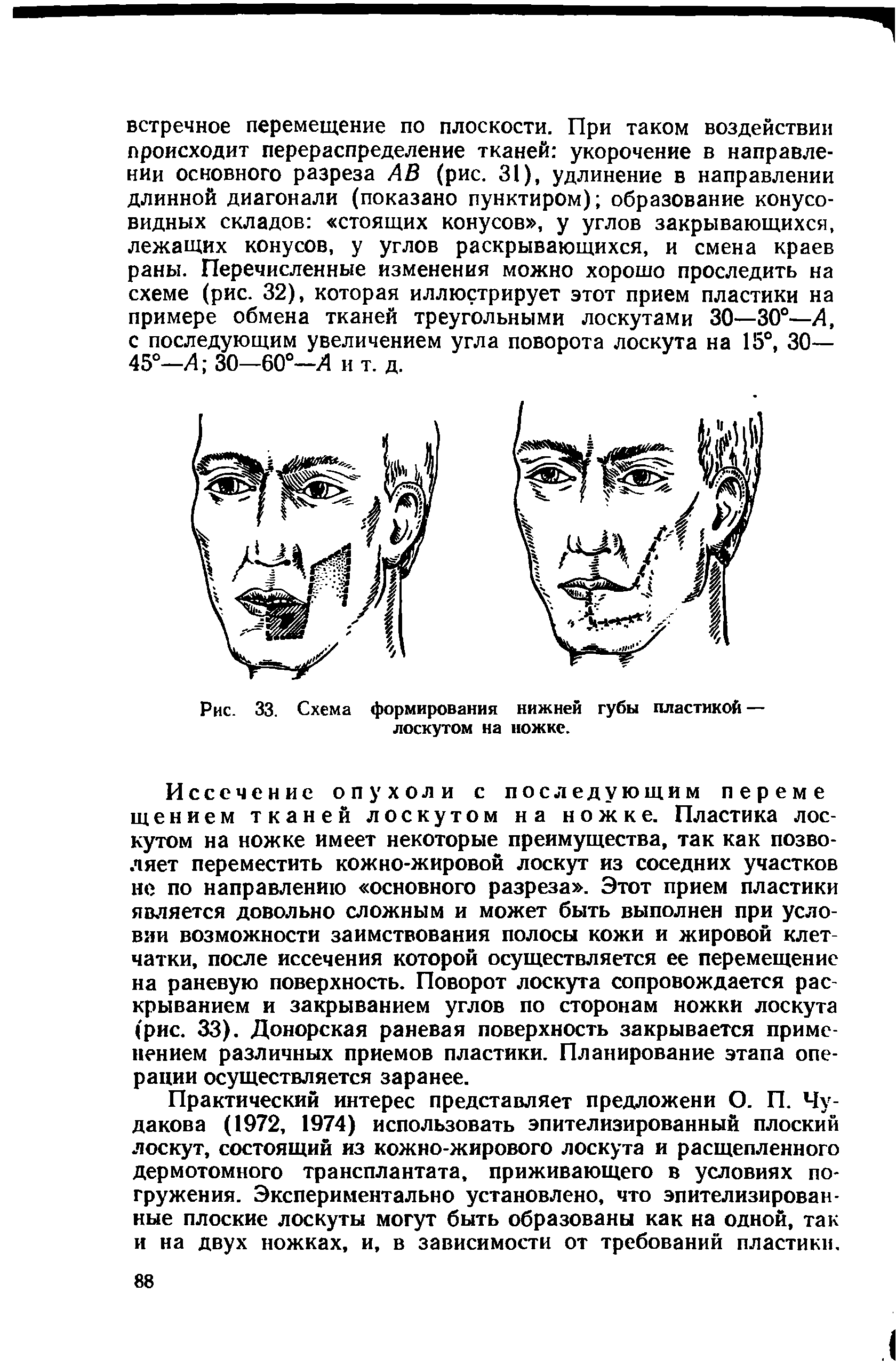 Рис. 33. Схема формирования нижней губы пластикой — лоскутом на ножке.