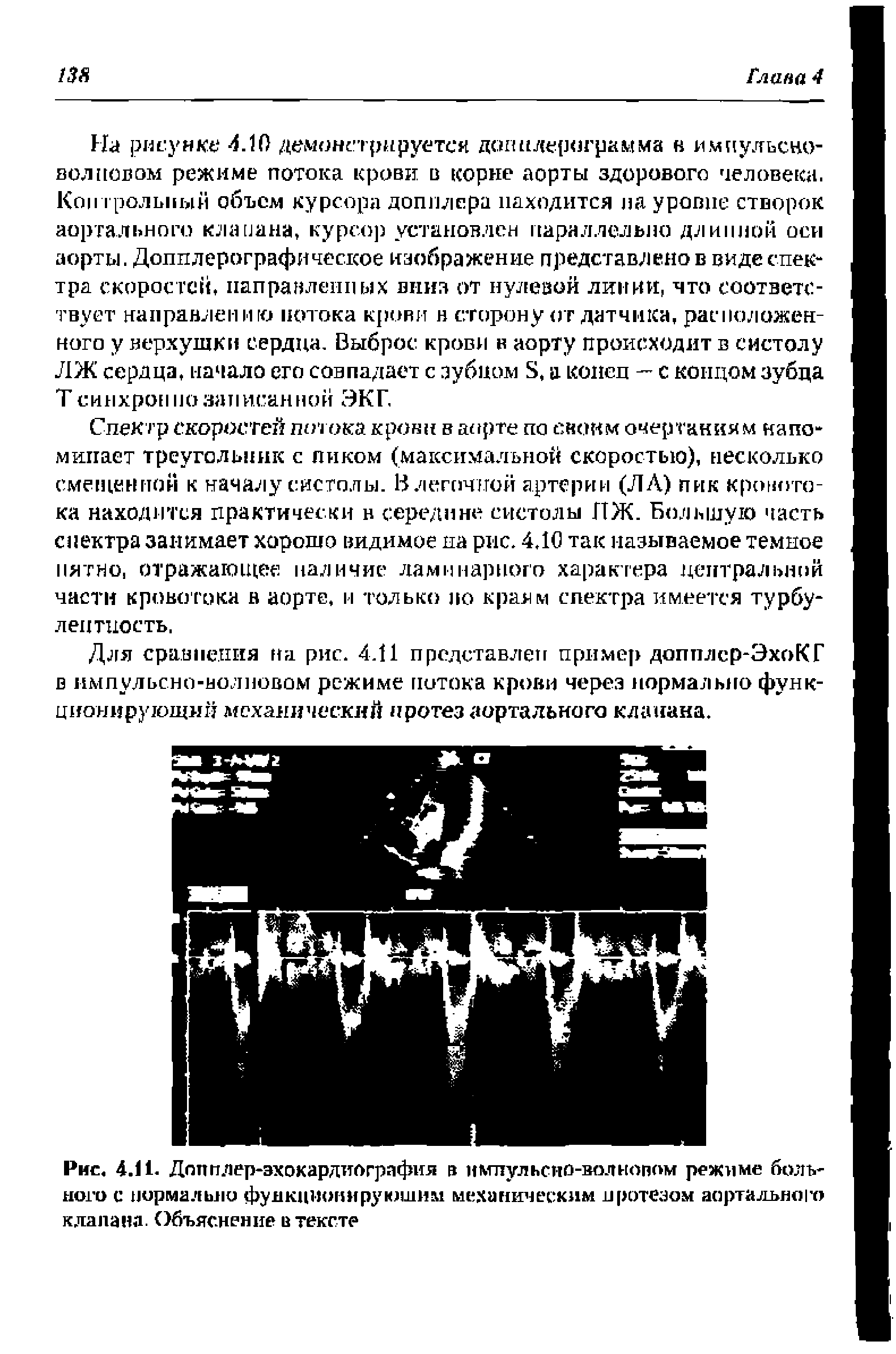 Рис. 4.11. Допплер-эхокардиография в нмиульсно-вол новом режиме больного с нормально функционирующим механическим протезом аортального клапана. Объяснение в тексте...