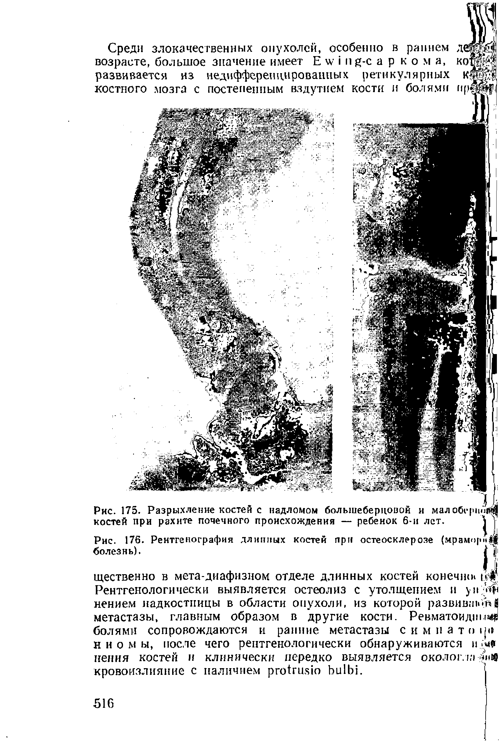 Рис. 175. Разрыхление костей с надломом большеберцовой и ма. костей при рахите почечного происхождения — ребенок 6-и лет.