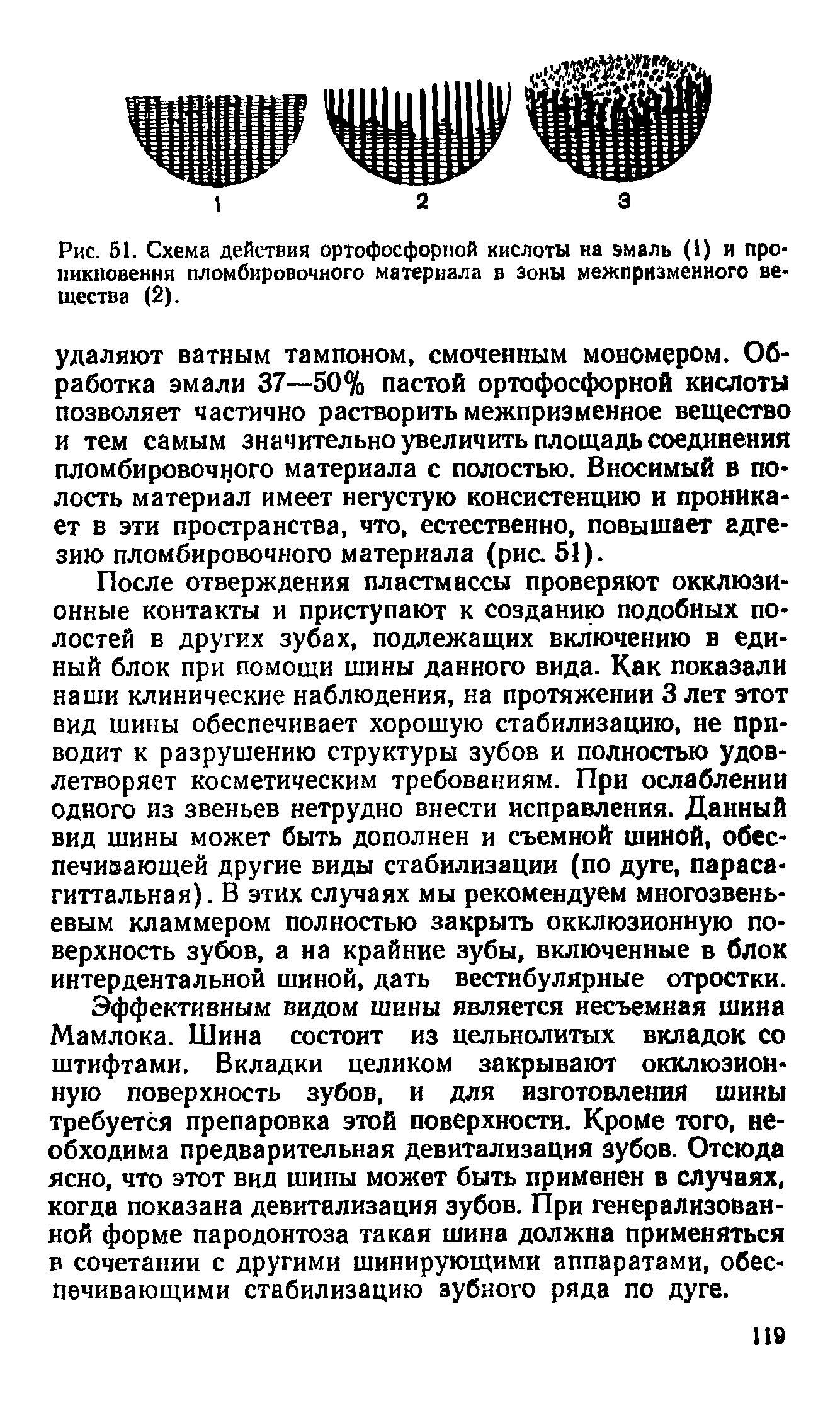 Рис. 51. Схема действия ортофосфорной кислоты на эмаль (1) и проникновения пломбировочного материала в зоны межпризменного вещества (2).