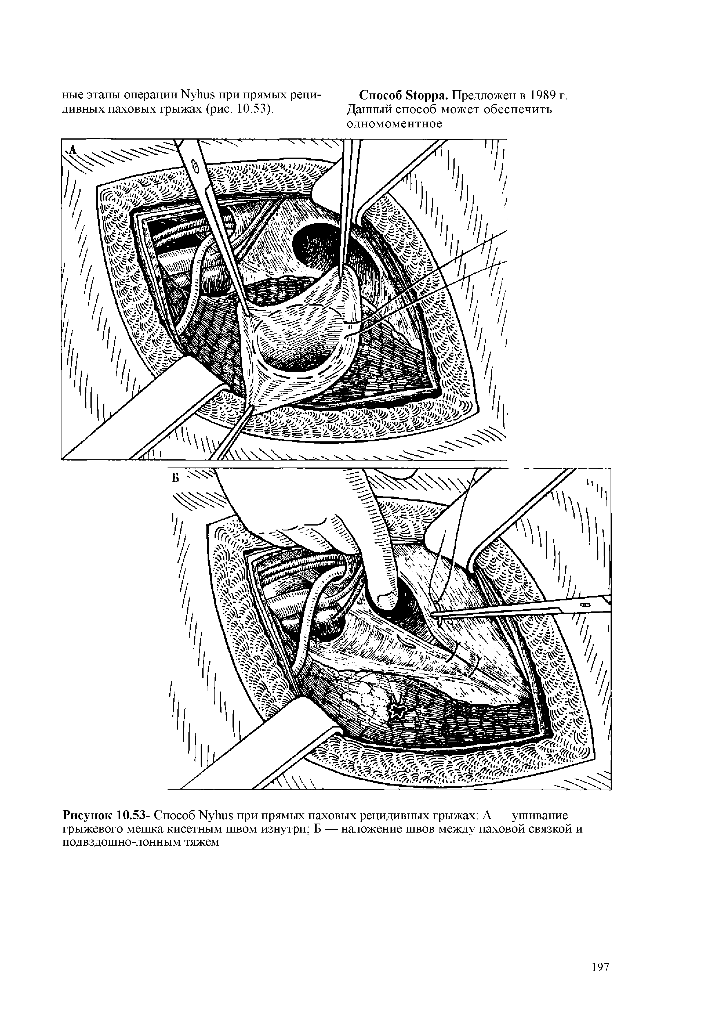 Рисунок 10.53- Способ N при прямых паховых рецидивных грыжах А — ушивание грыжевого мешка кисетным швом изнутри Б — наложение швов между паховой связкой и подвздошно-лонным тяжем...