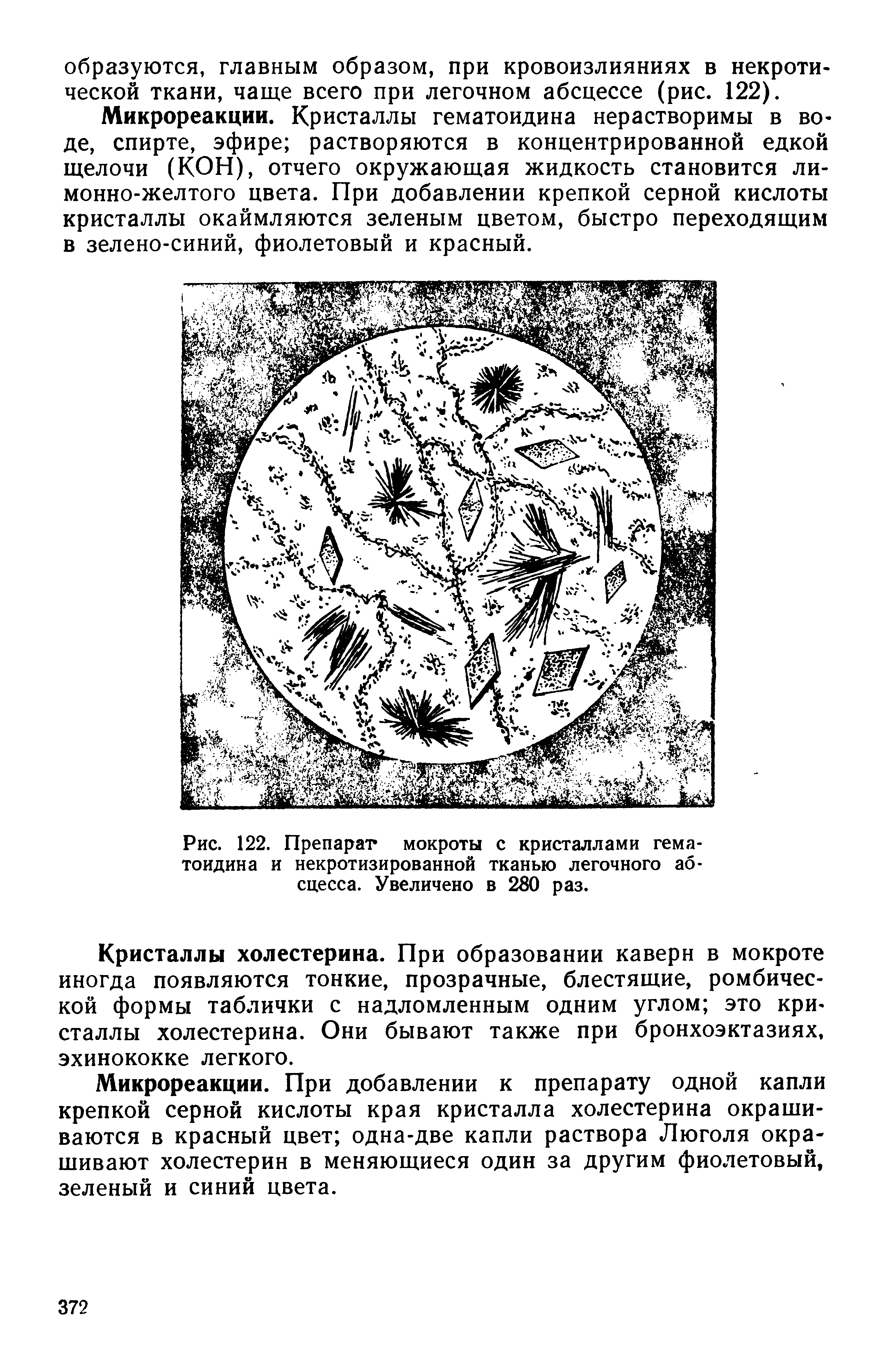 Рис. 122. Препарат мокроты с кристаллами гематоидина и некротизированной тканью легочного абсцесса. Увеличено в 280 раз.