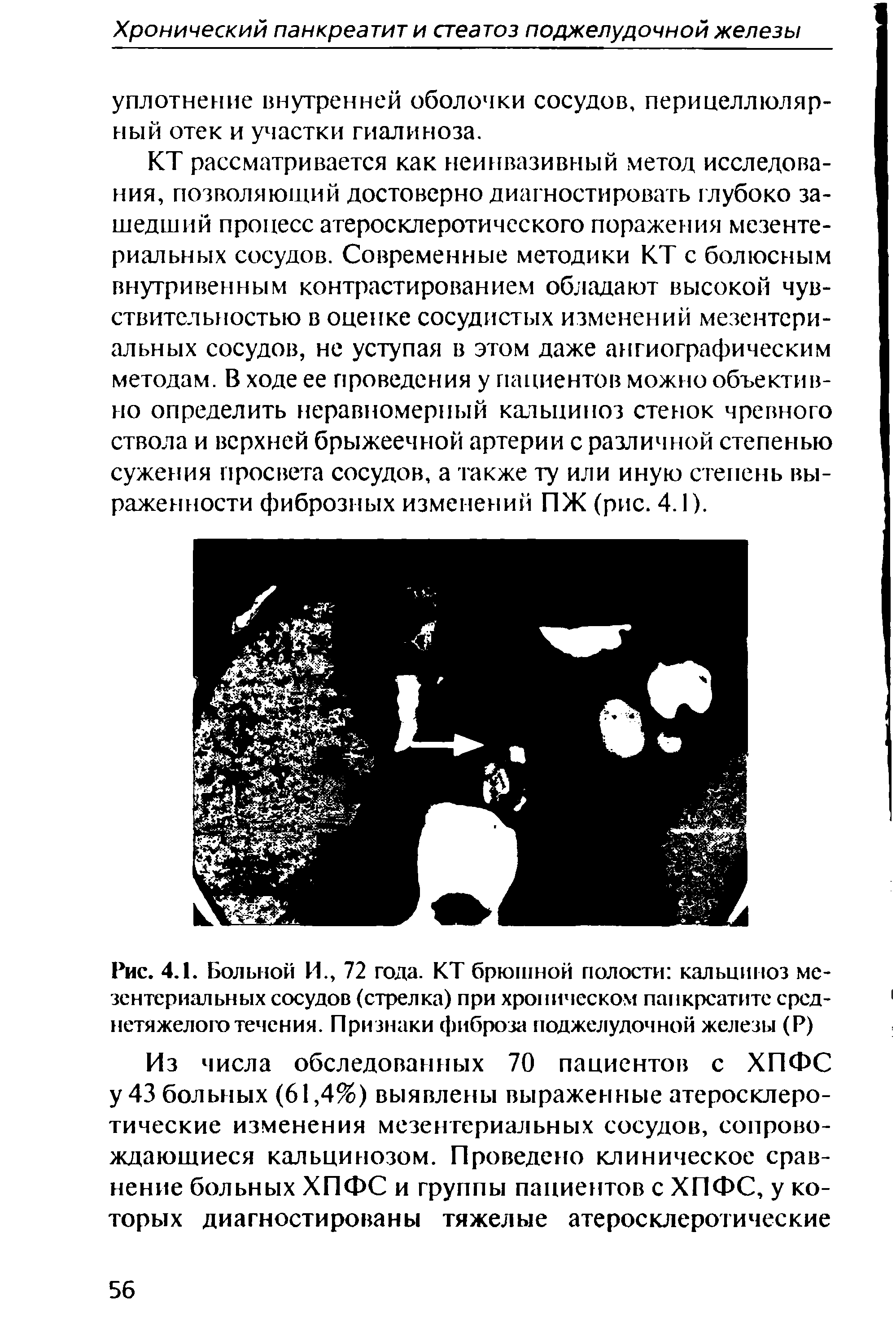 Рис. 4.1. Больной И., 72 года. КТ брюшной полости кальциноз мезентериальных сосудов (стрелка) при хроническом панкреатите среднетяжелого течения. Признаки фиброза поджелудочной железы (Р)...